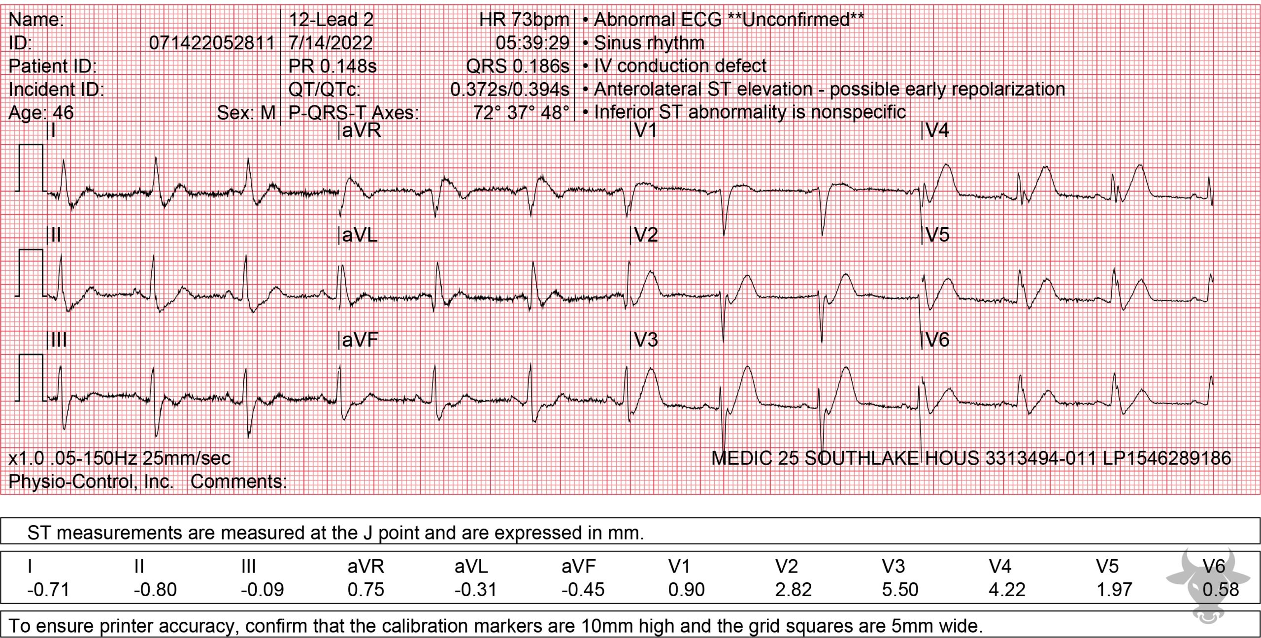 ECG Showing Hyperacute T Waves