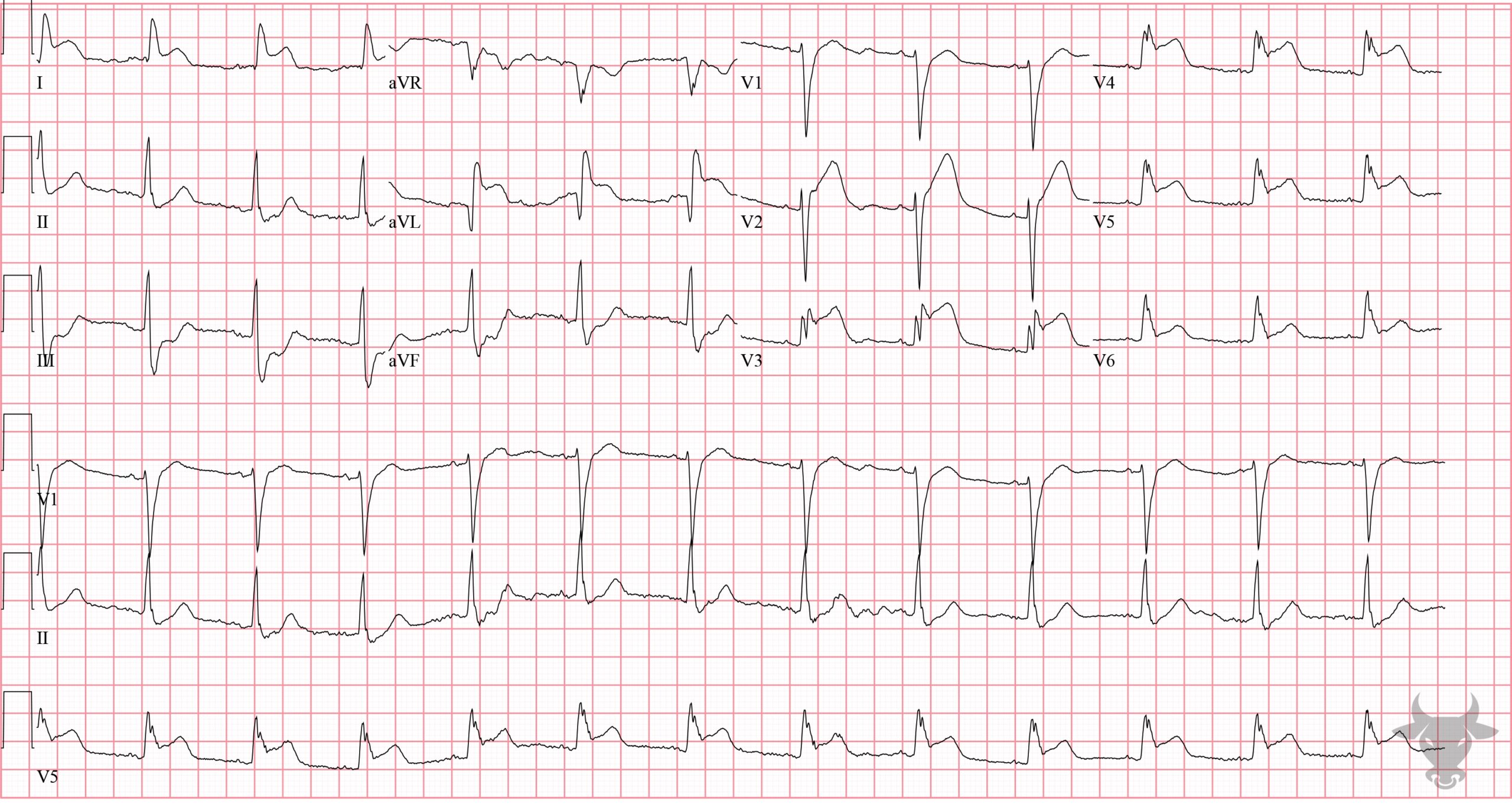 ECG Showing ST-elevation Myocardial Infarction