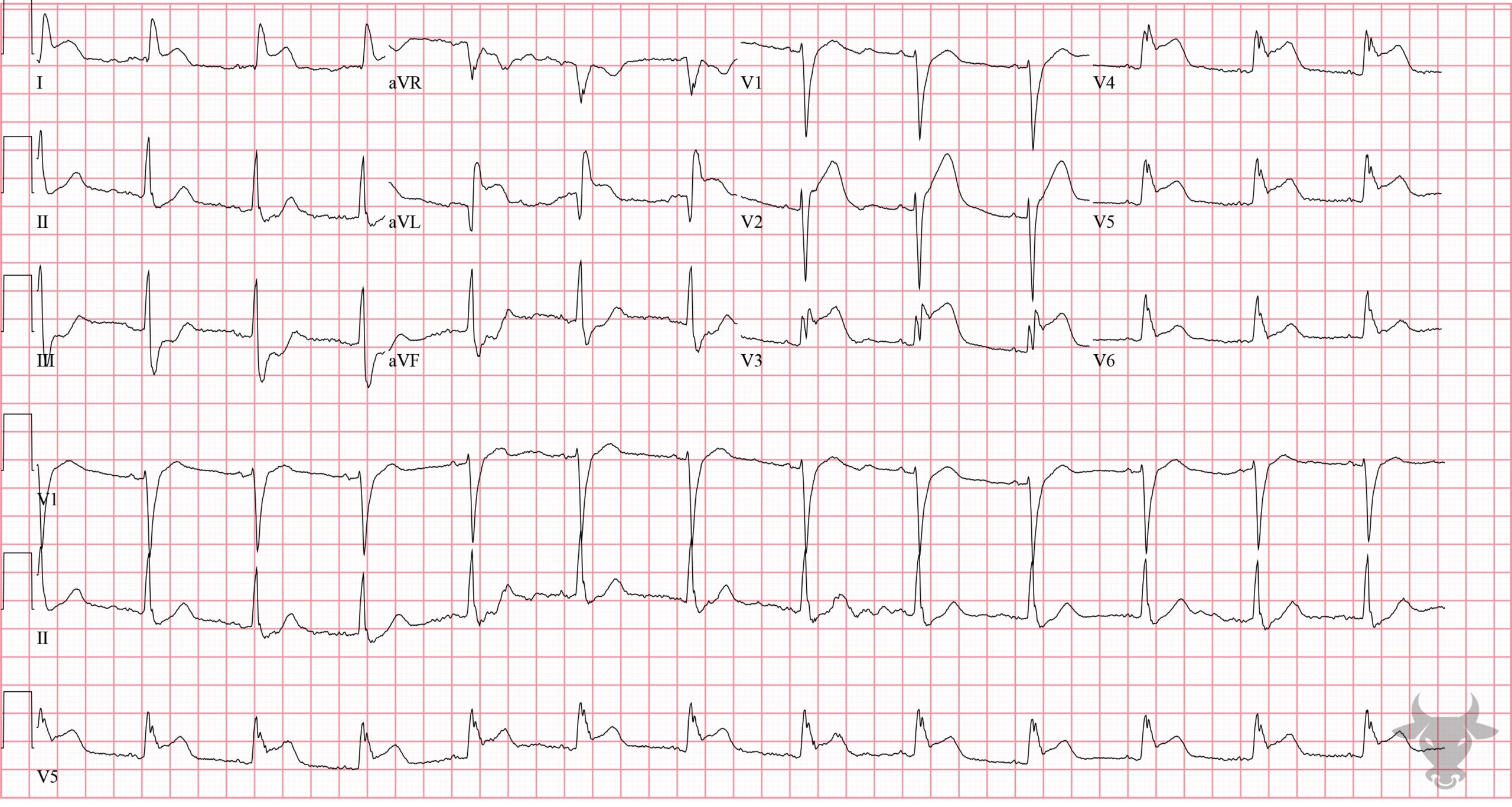 ECG Showing ST-elevation Myocardial Infarction