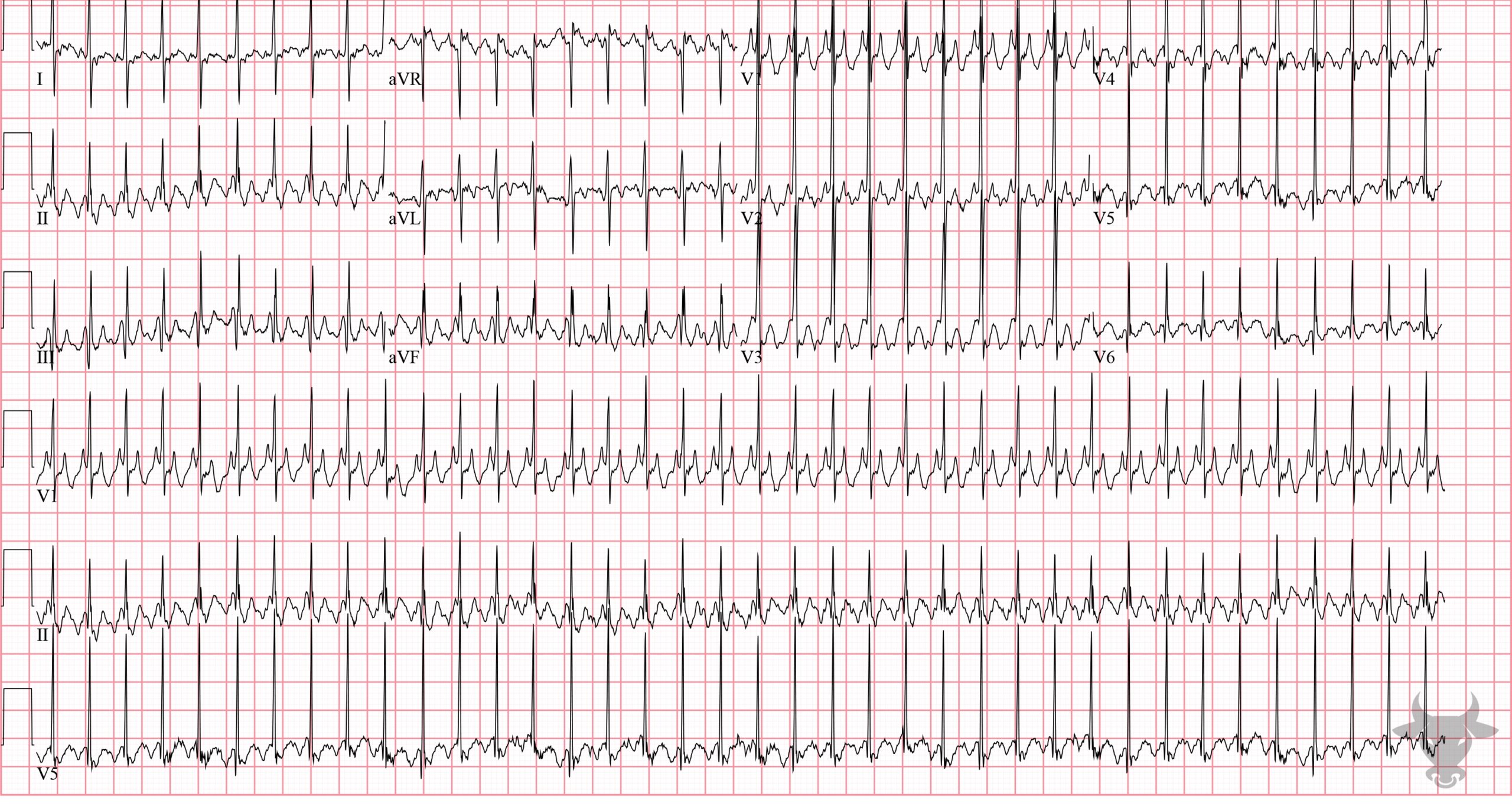 ECG Showing Atrial Flutter