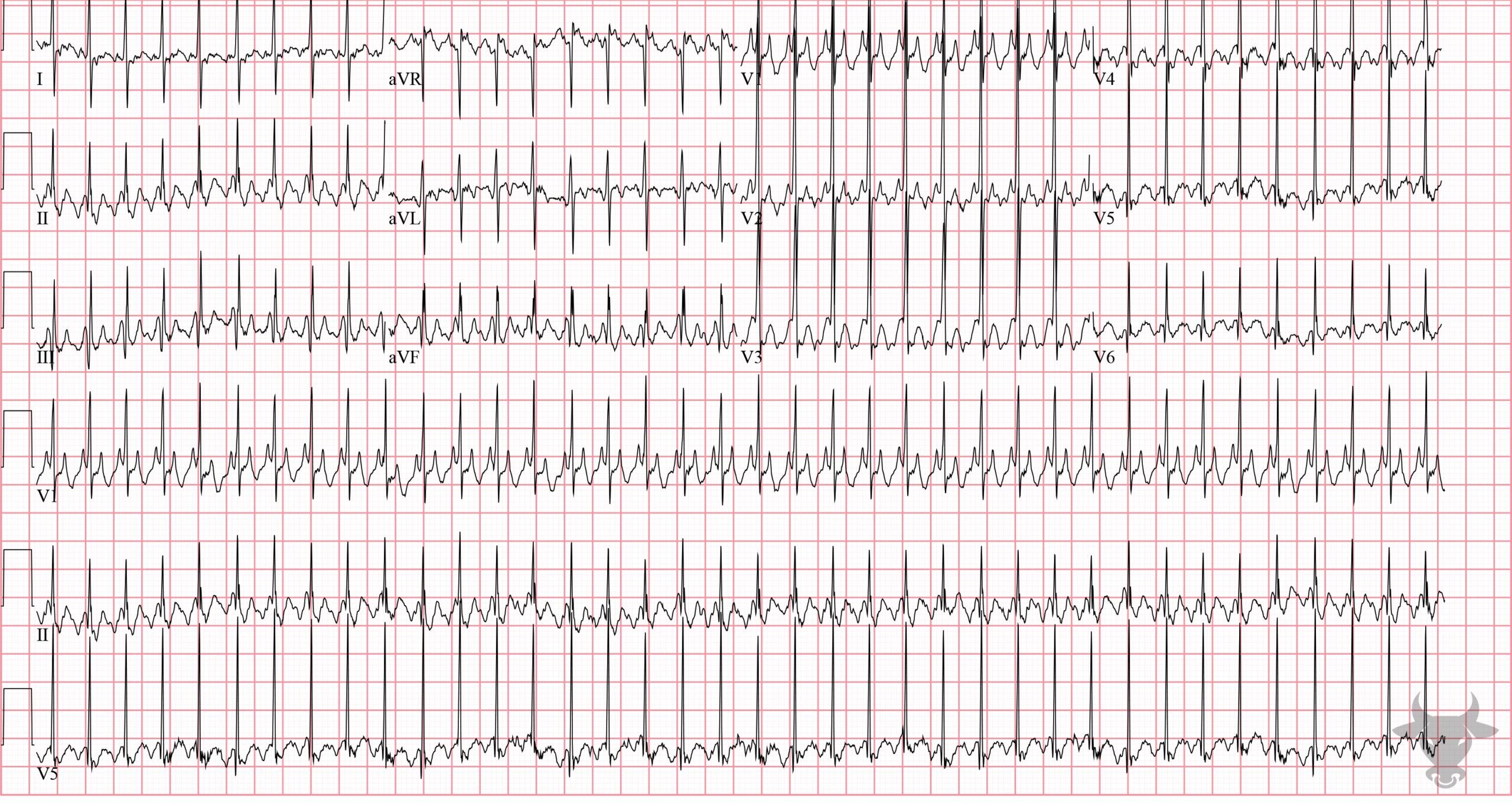 ECG Showing Atrial Flutter