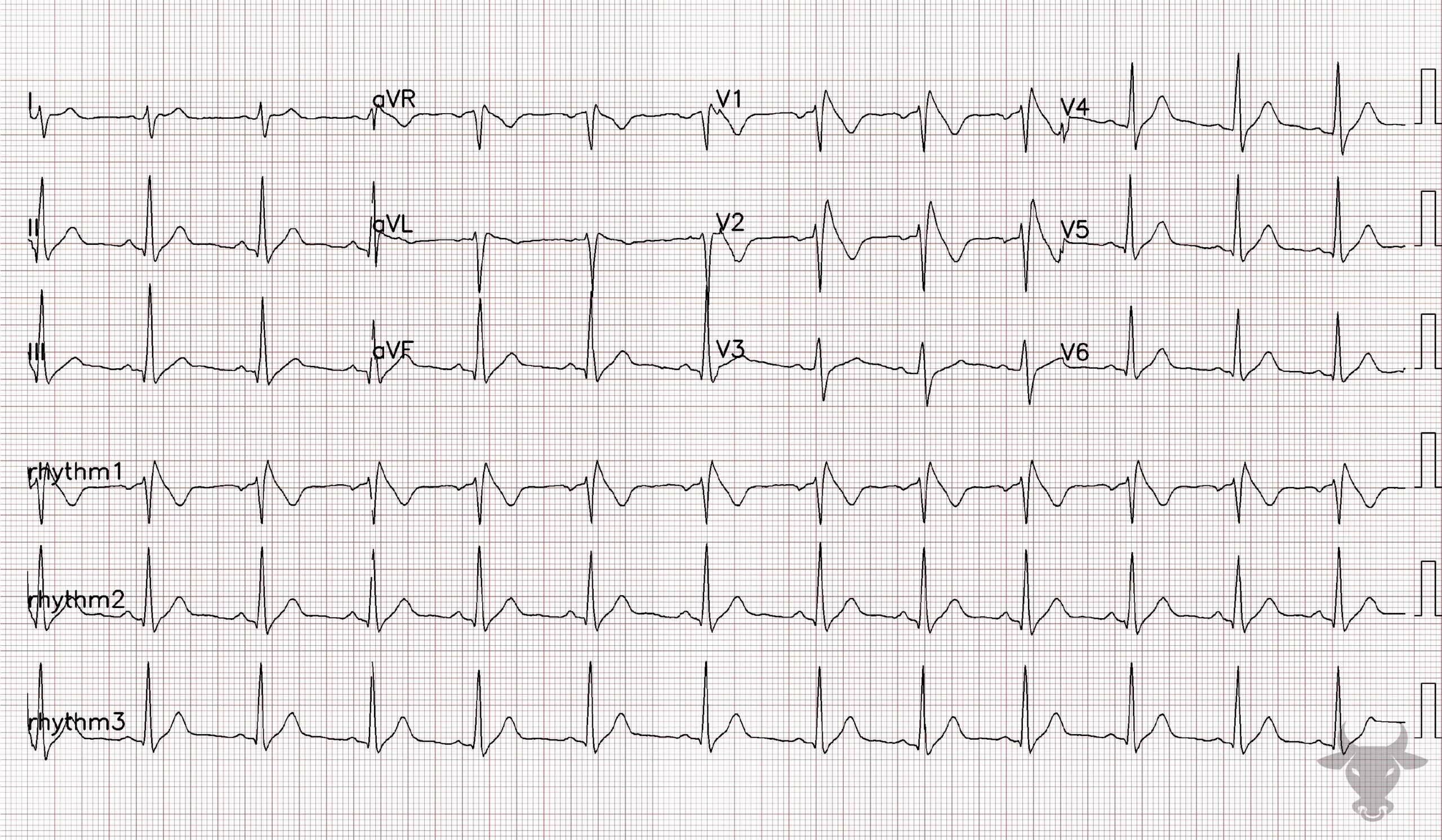 ECG Showing Brugada Syndrome