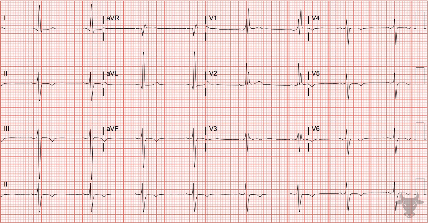 ECG Showing Bifascicular Block