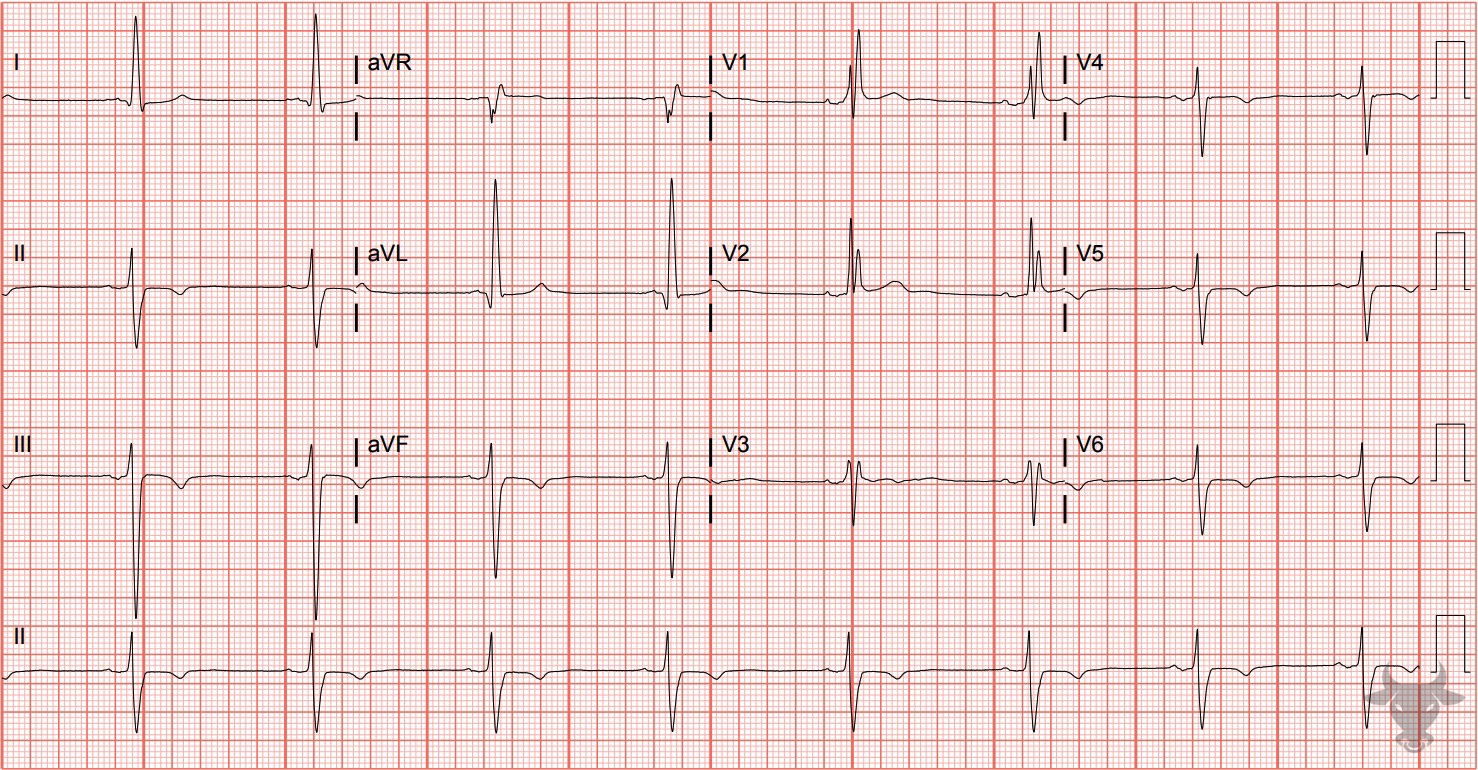 ECG Showing Bifascicular Block