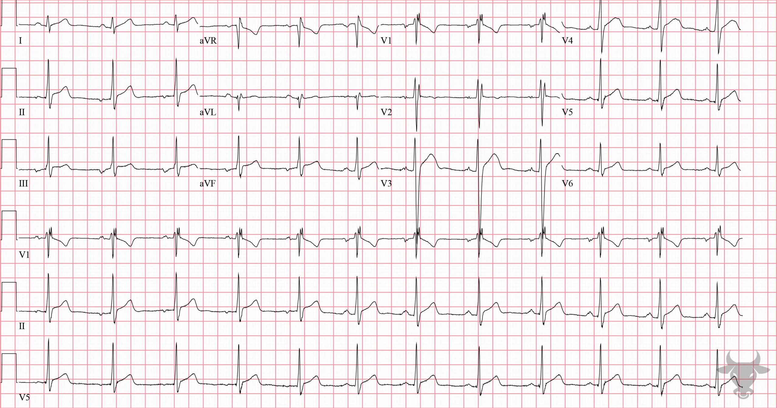 ECG Showing Right Bundle Branch Block