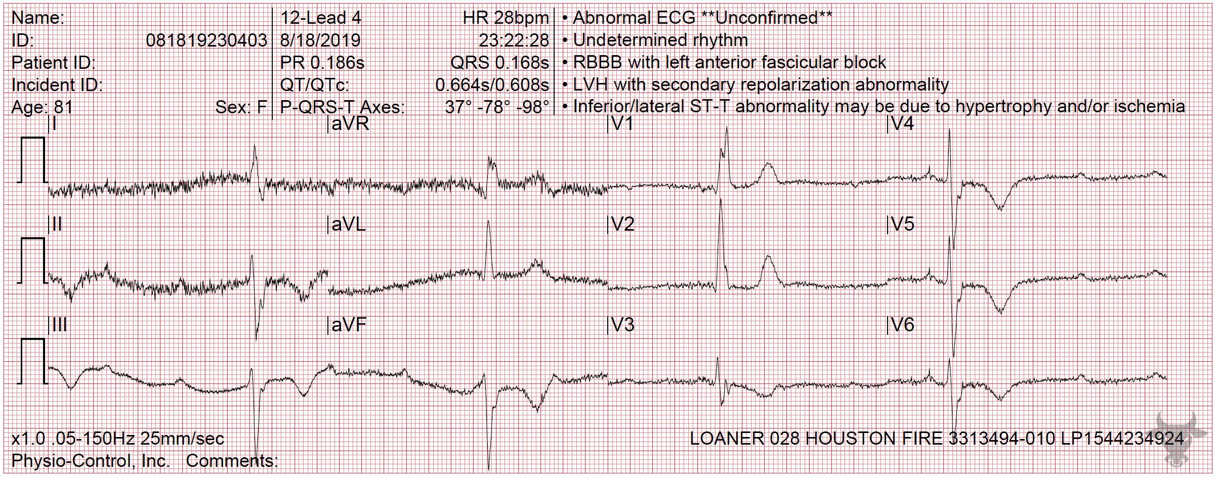 ECG Showing Third Degree Atrioventricular Block