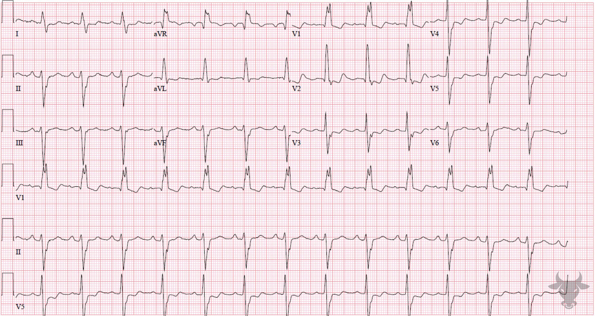 ECG Showing Trifascicular Block