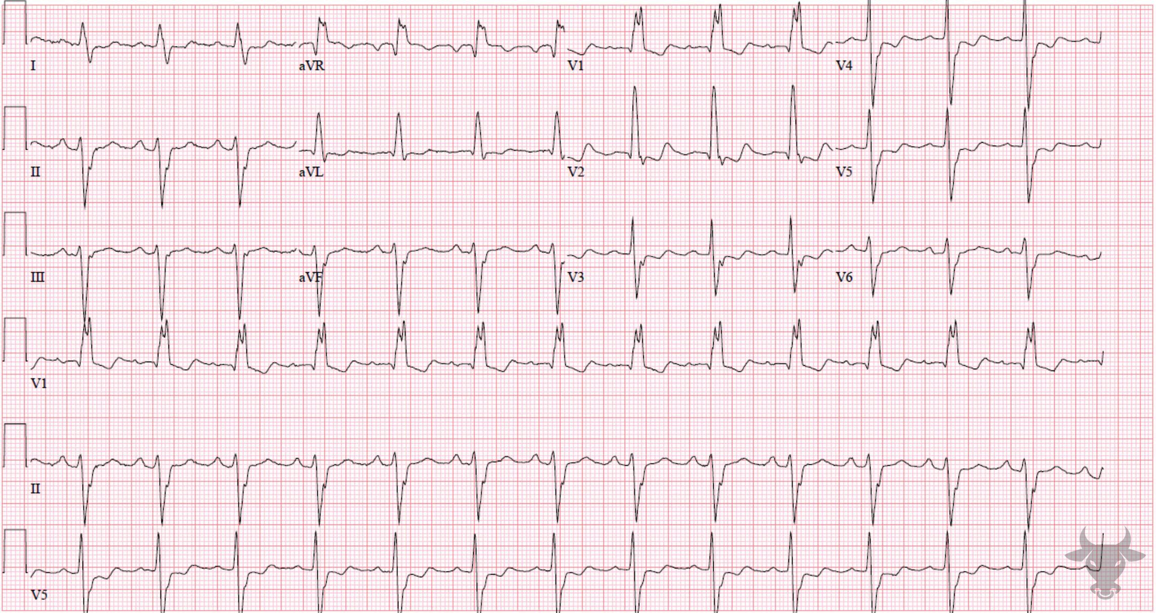 ECG Showing Trifascicular Block