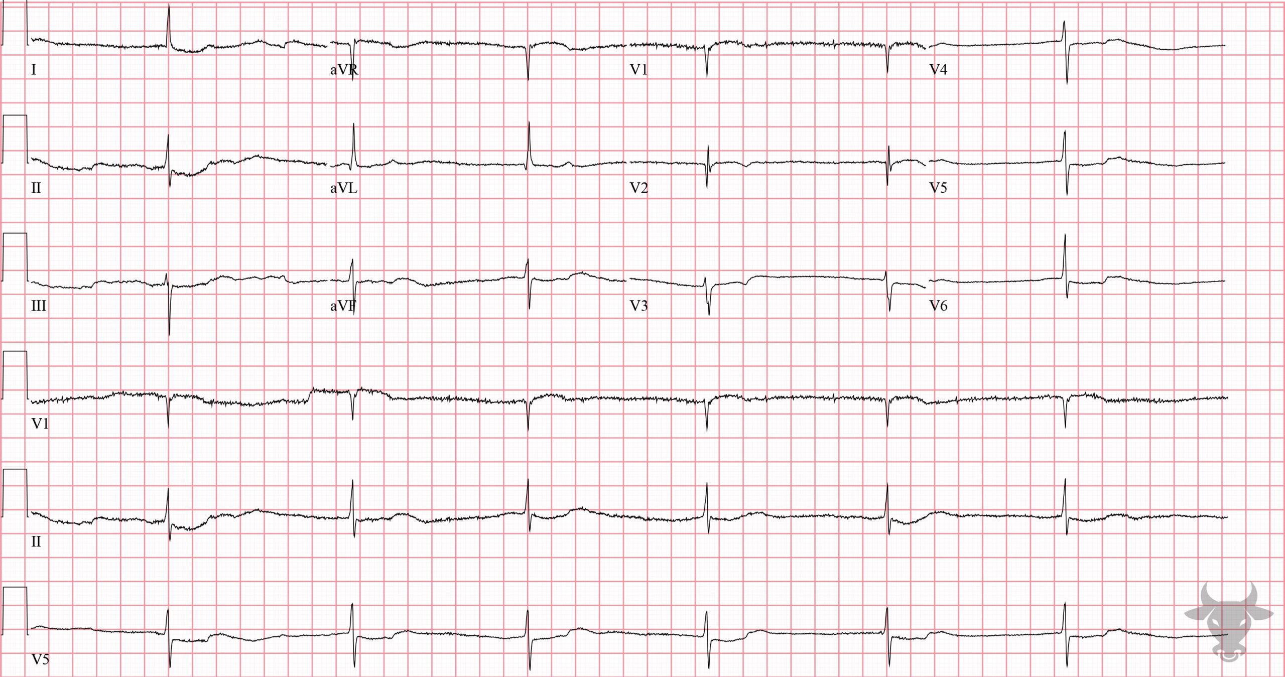 ECG Showing Digoxin Toxicity