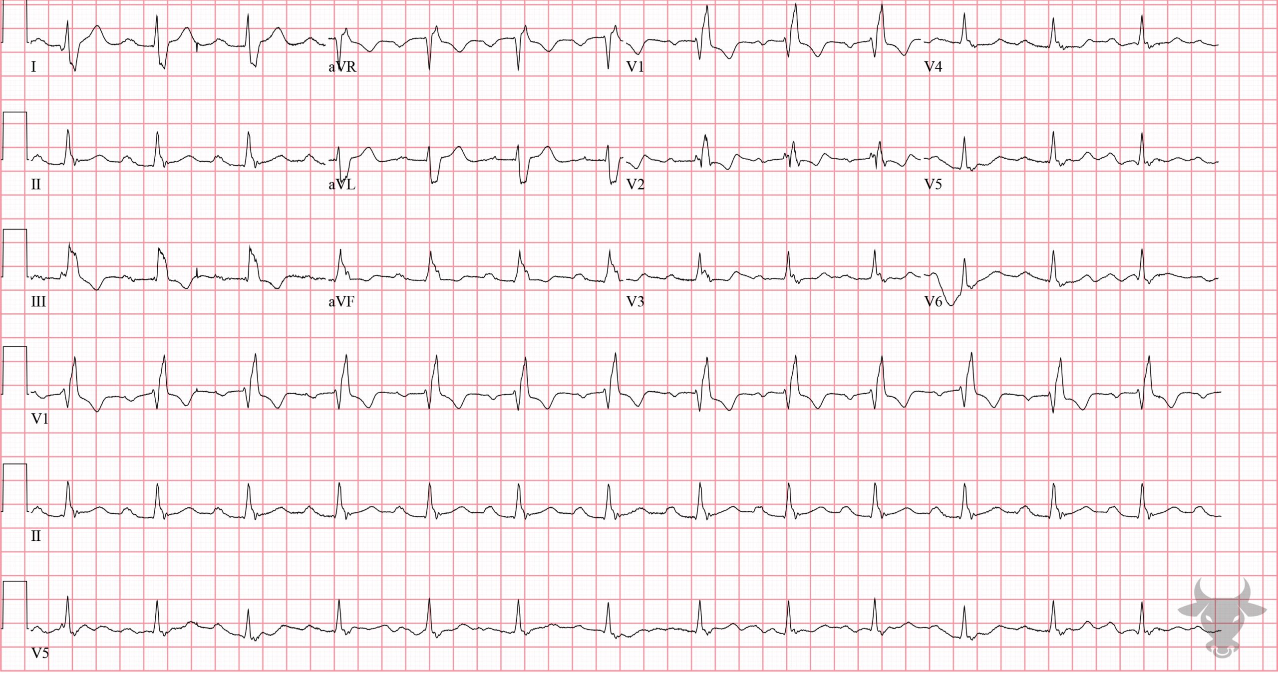 ECG Showing Right Bundle Branch Block
