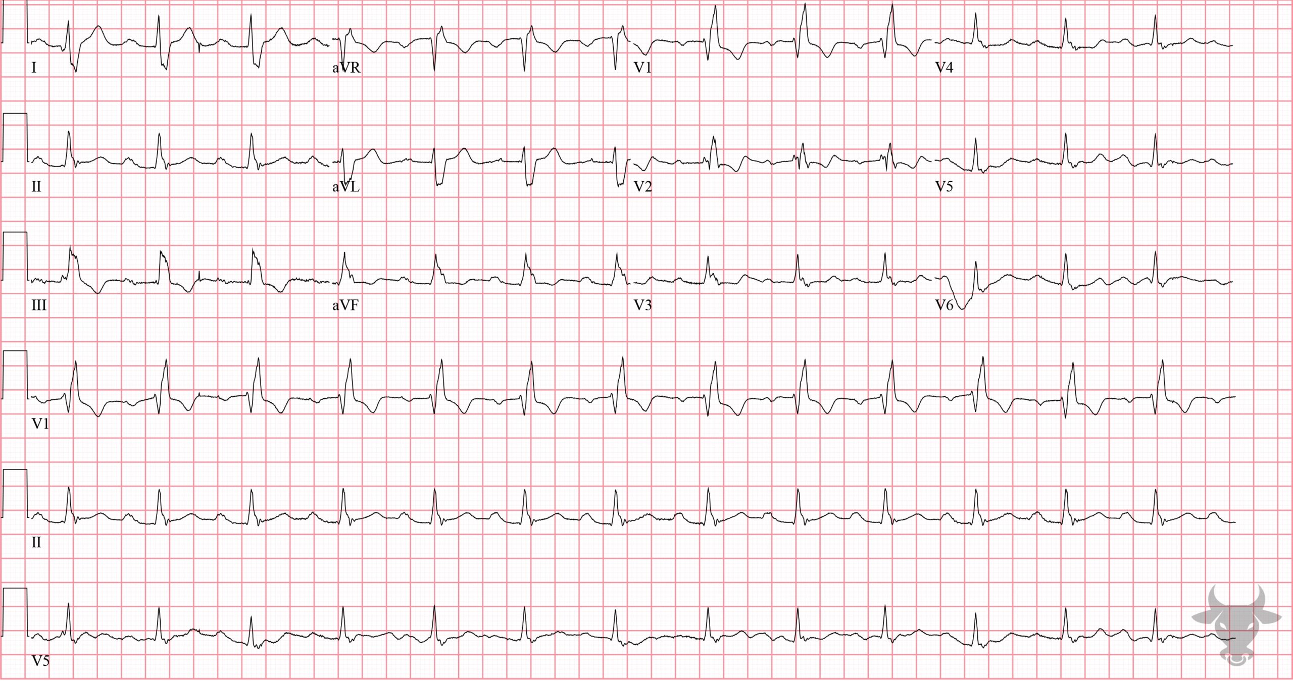 ECG Showing Right Bundle Branch Block