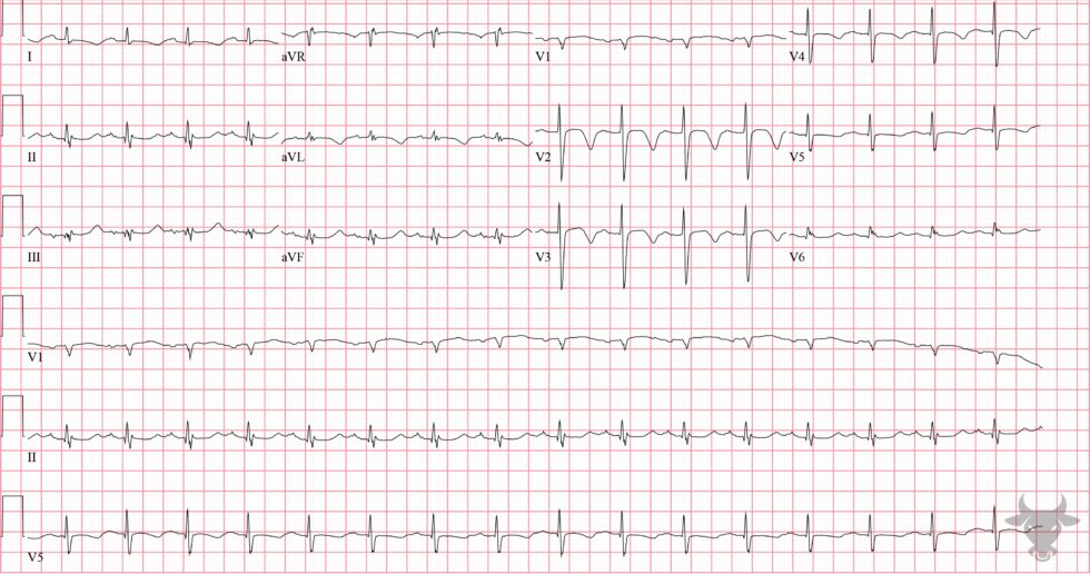 Cerebral T waves | ECG Stampede