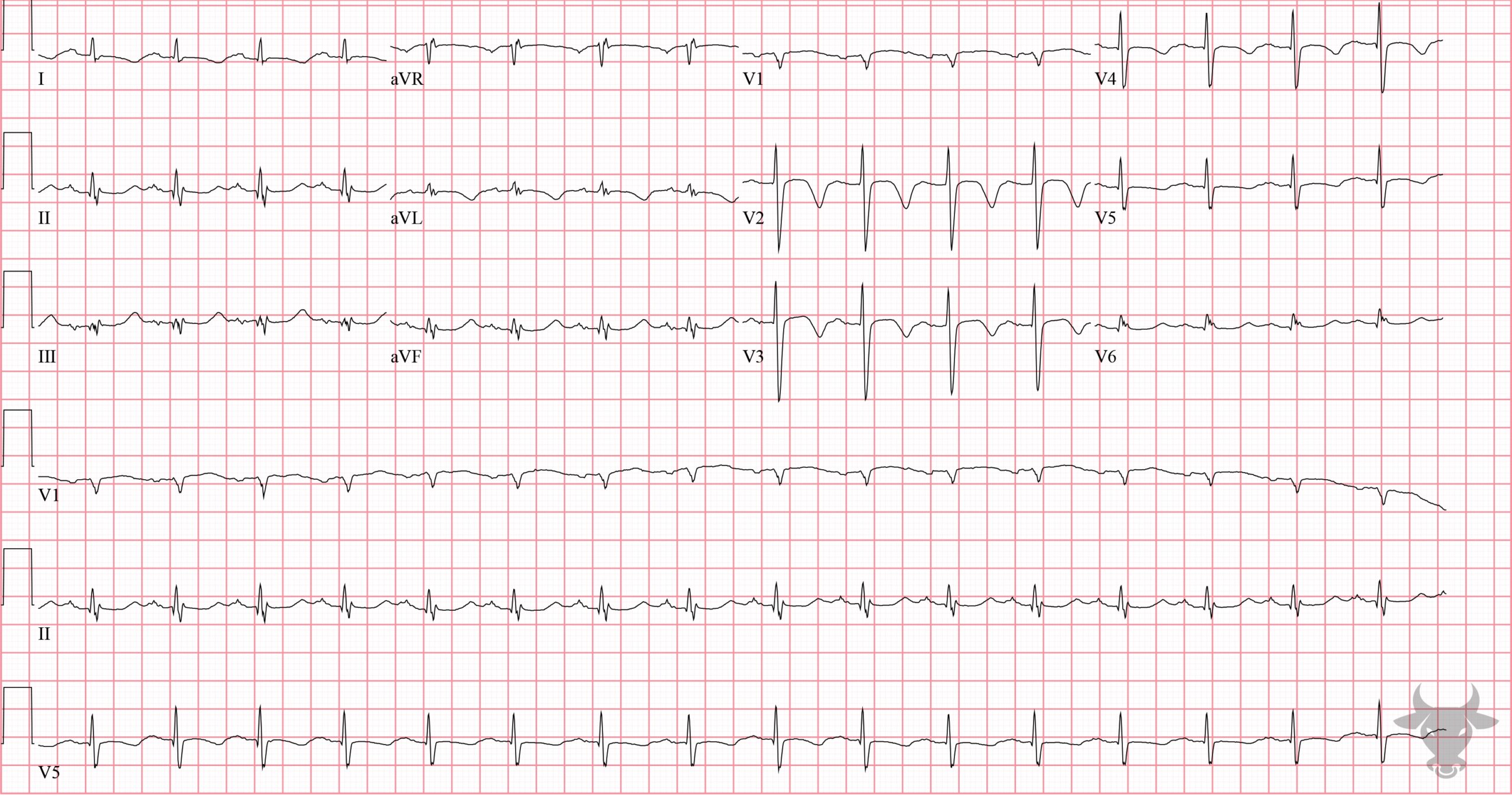 ECG Showing Cerebral T waves