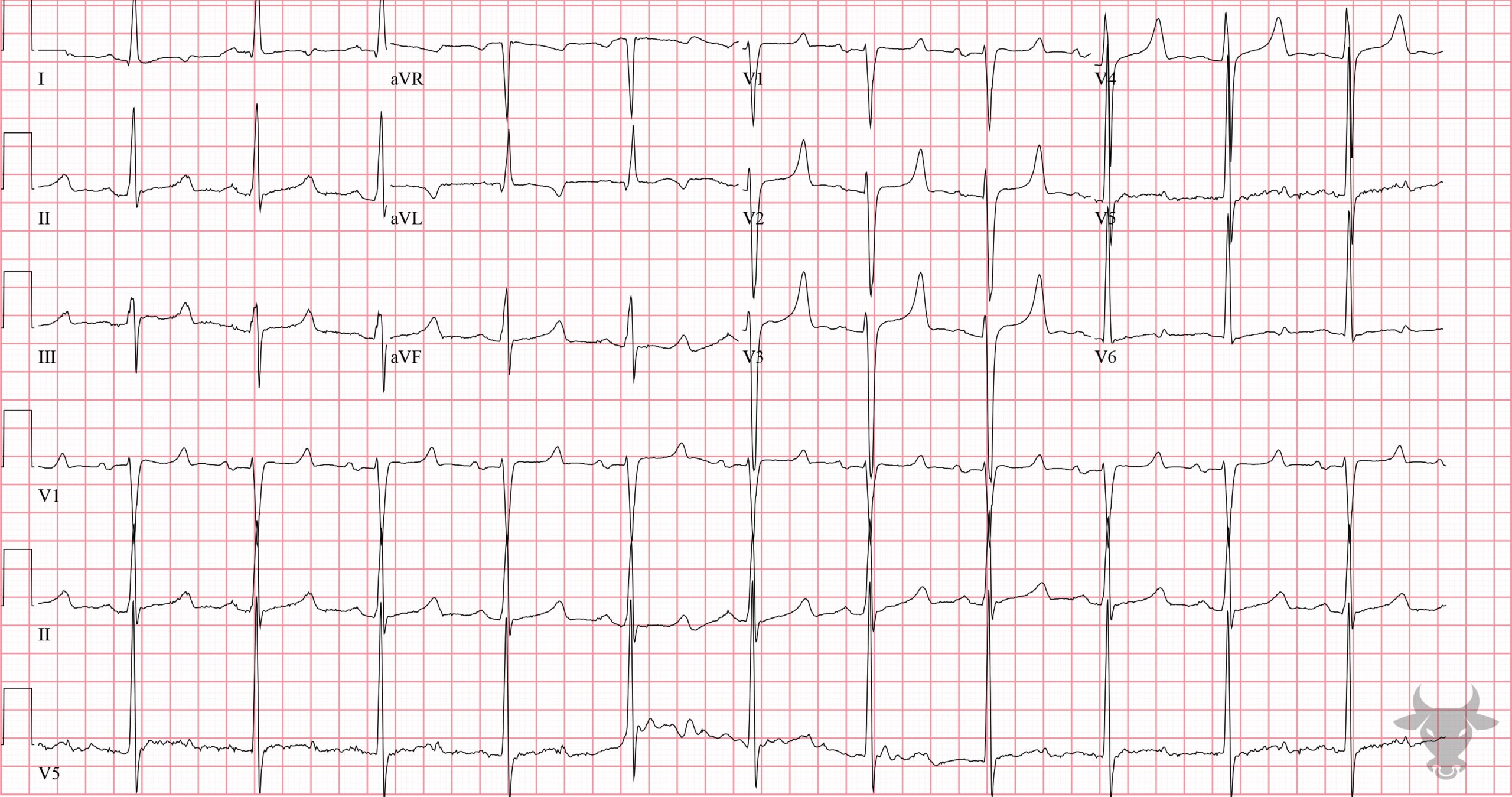 ECG Showing Hypocalcemia