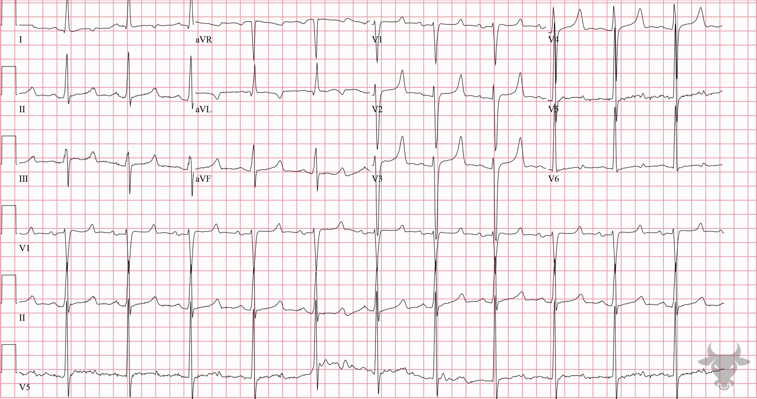 ECG Showing Hyperkalemia and Hypocalcemia