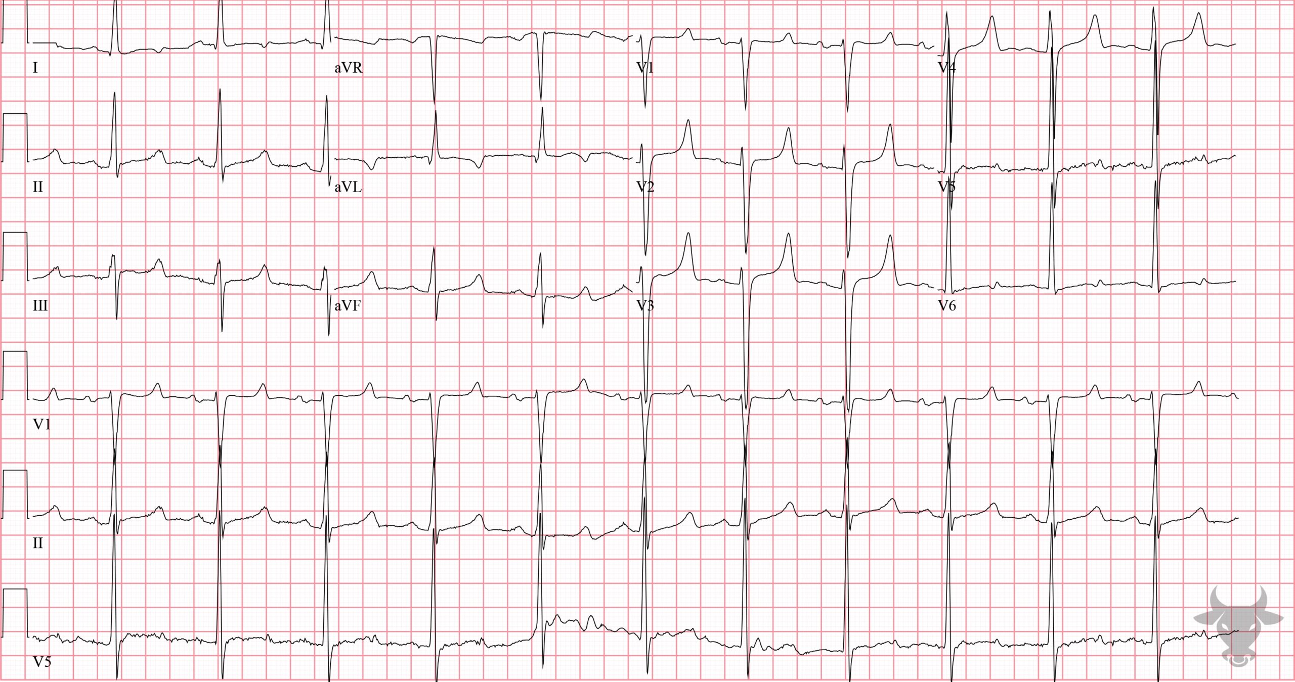 ECG Showing Hyperkalemia and Hypocalcemia