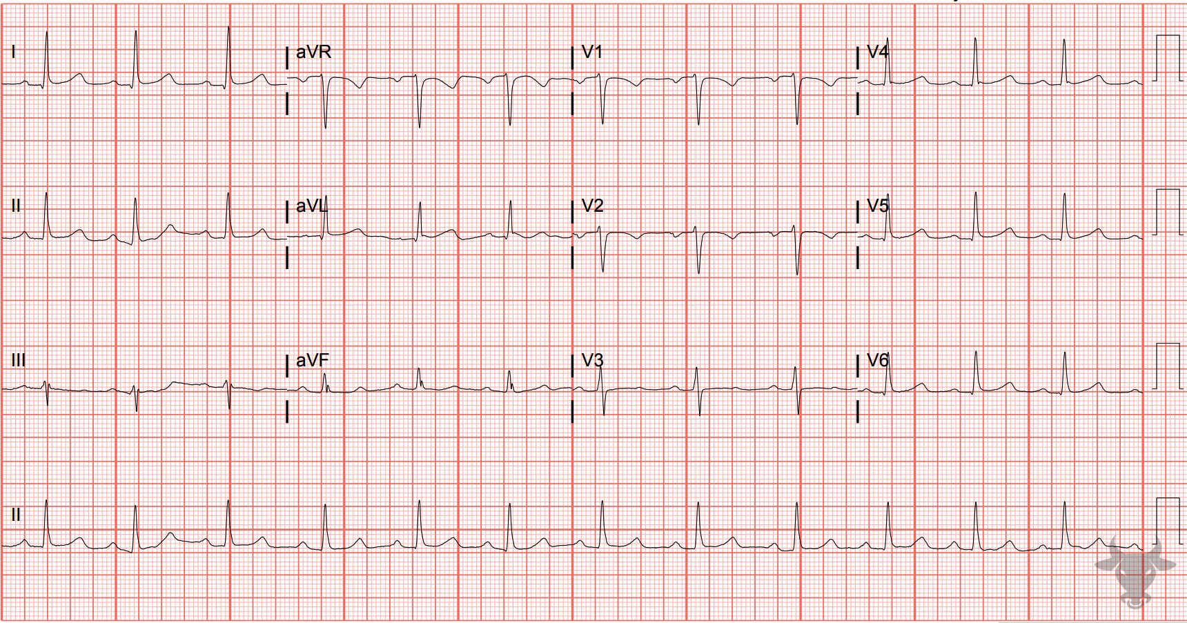 ECG Showing First Degree Atrioventricular Block