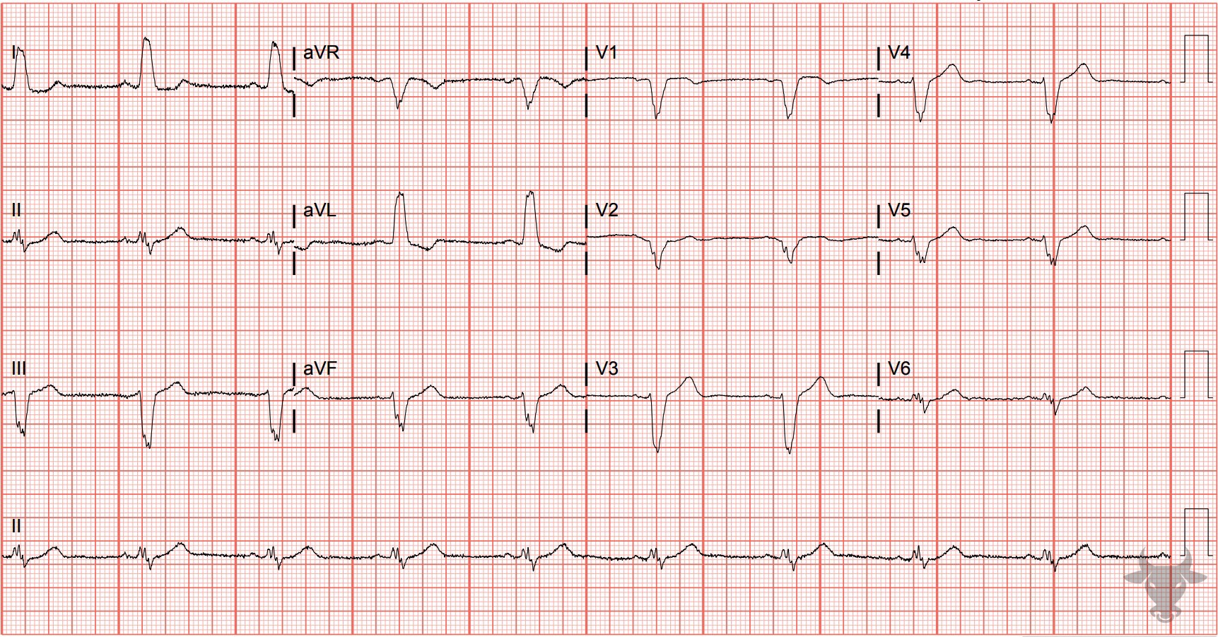 ECG Showing Left Bundle Branch Block