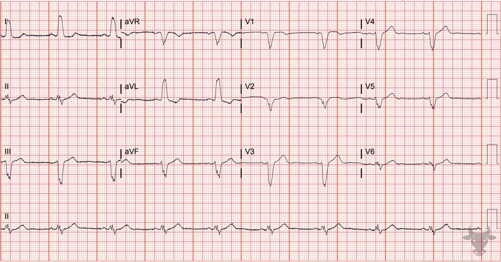 ECG Showing Left Bundle Branch Block