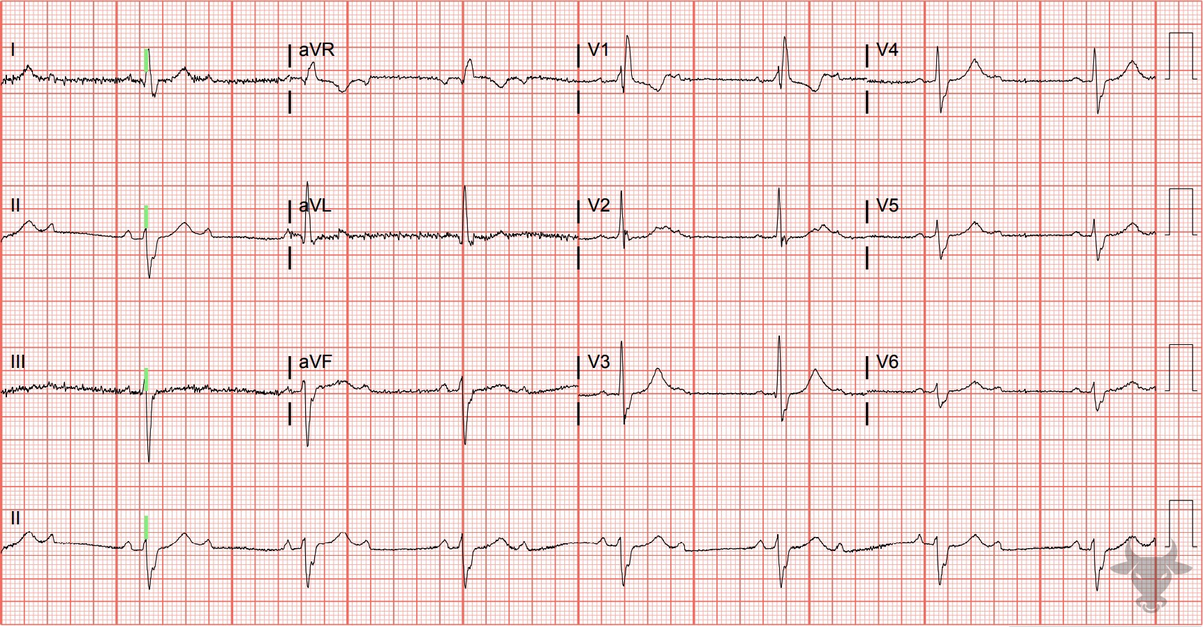 ECG Showing Second Degree Atrioventricular Block 2:1