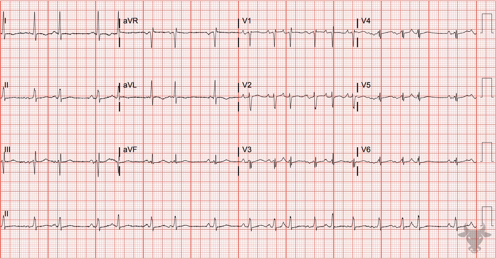 ECG Showing Multifocal Atrial Tachycardia