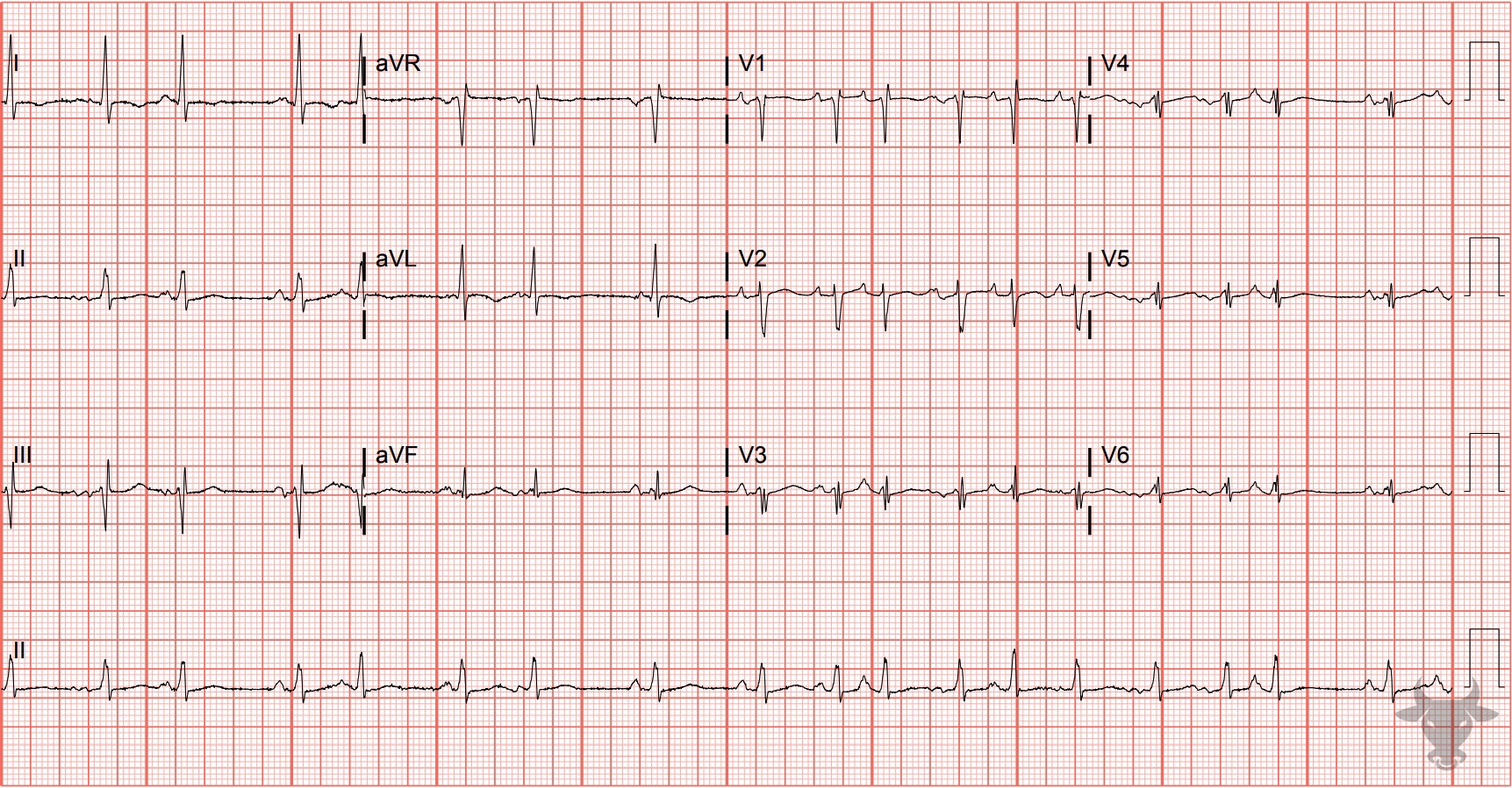ECG Showing Atrial Tachycardia