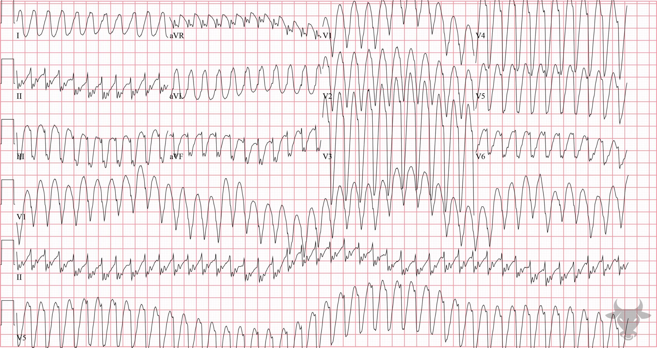 ECG Showing Ventricular Tachycardia