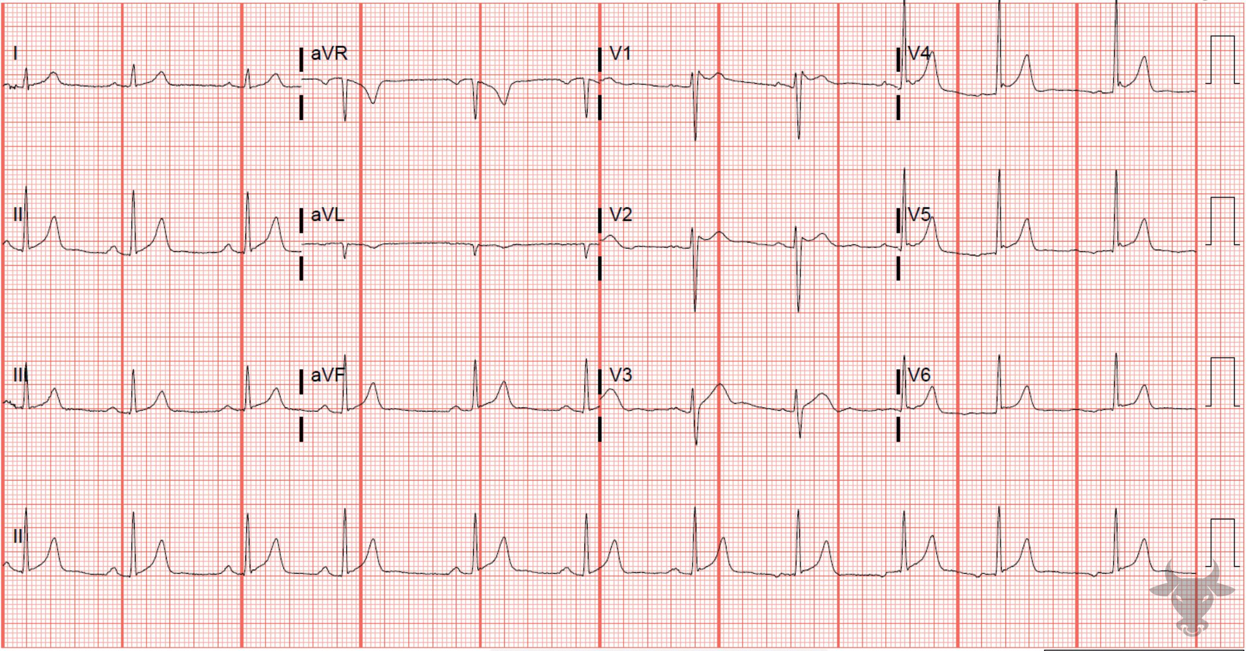 ECG Showing Right Bundle Branch Block