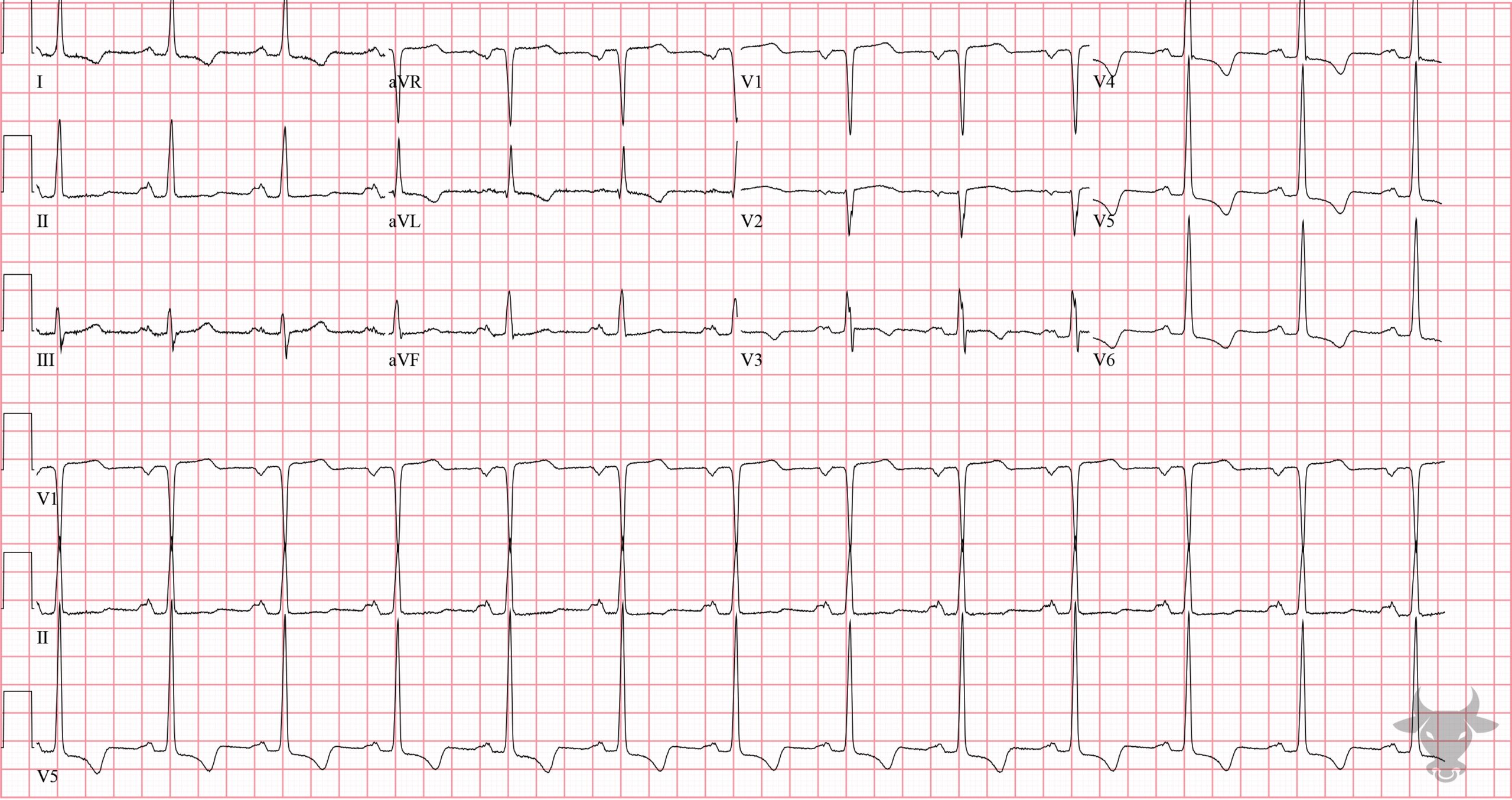 ECG Showing Left Atrial Enlargement