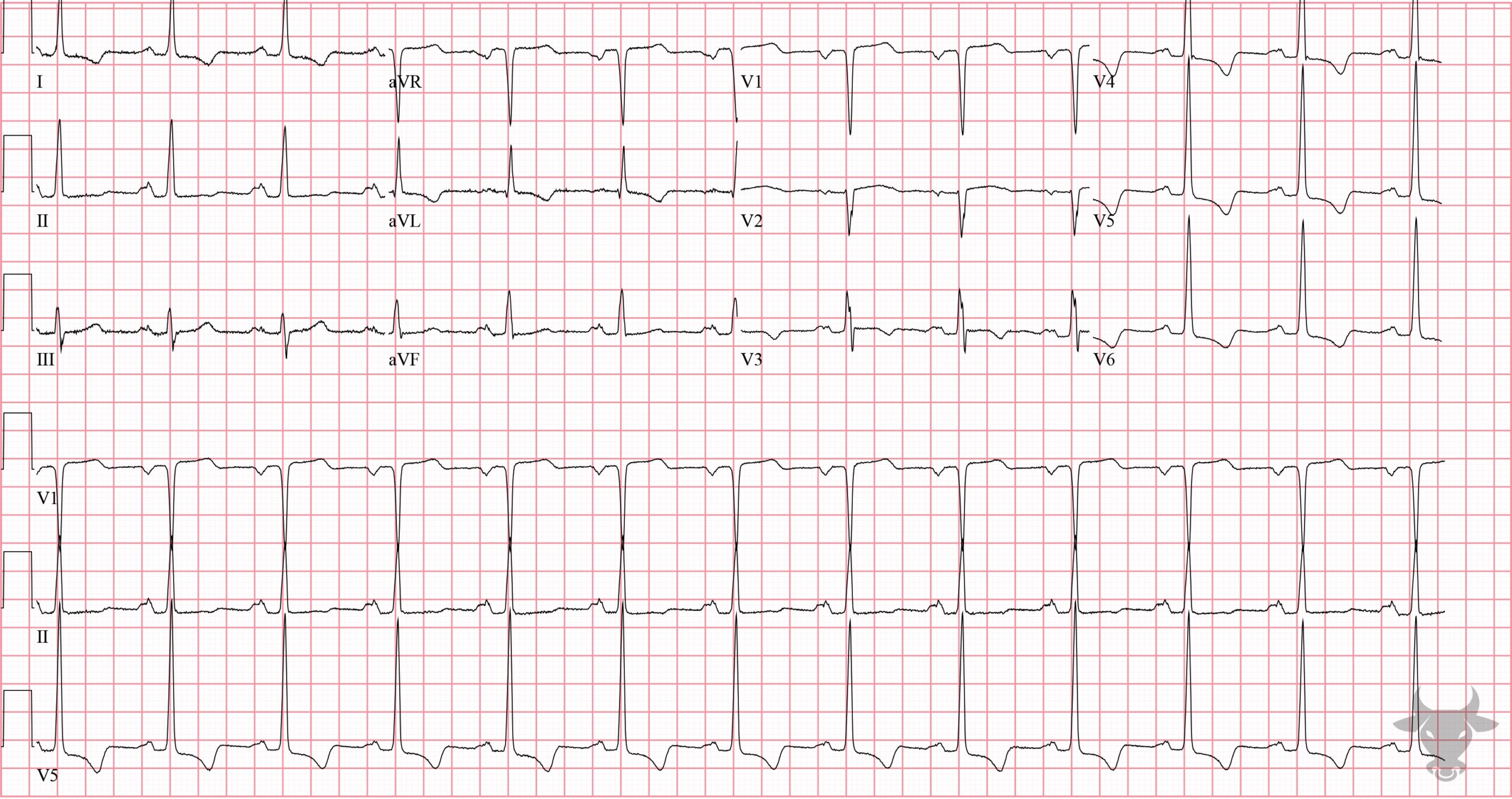 ECG Showing Left Atrial Enlargement