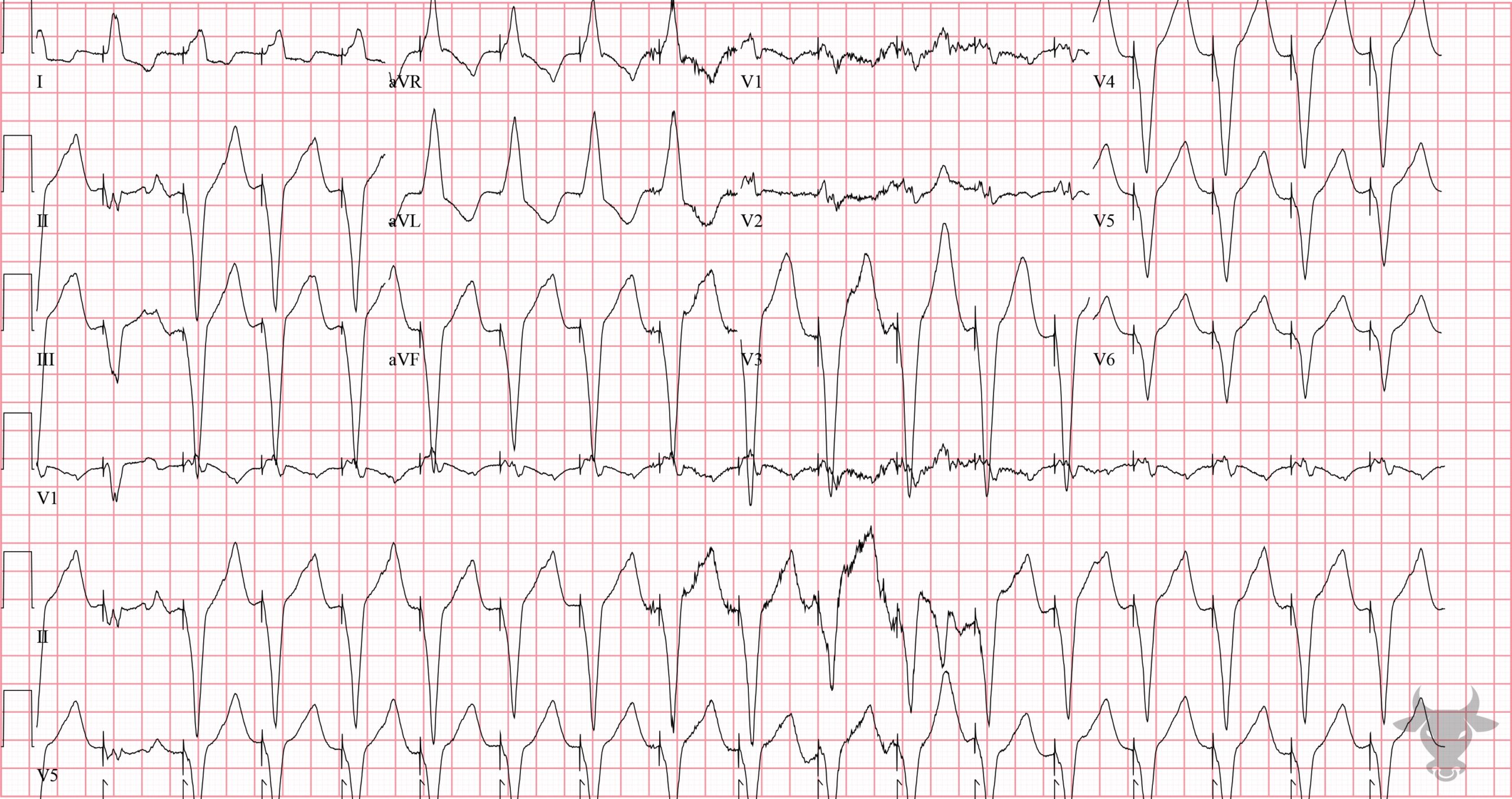 ECG Showing Pacemaker Mediated Tachycardia