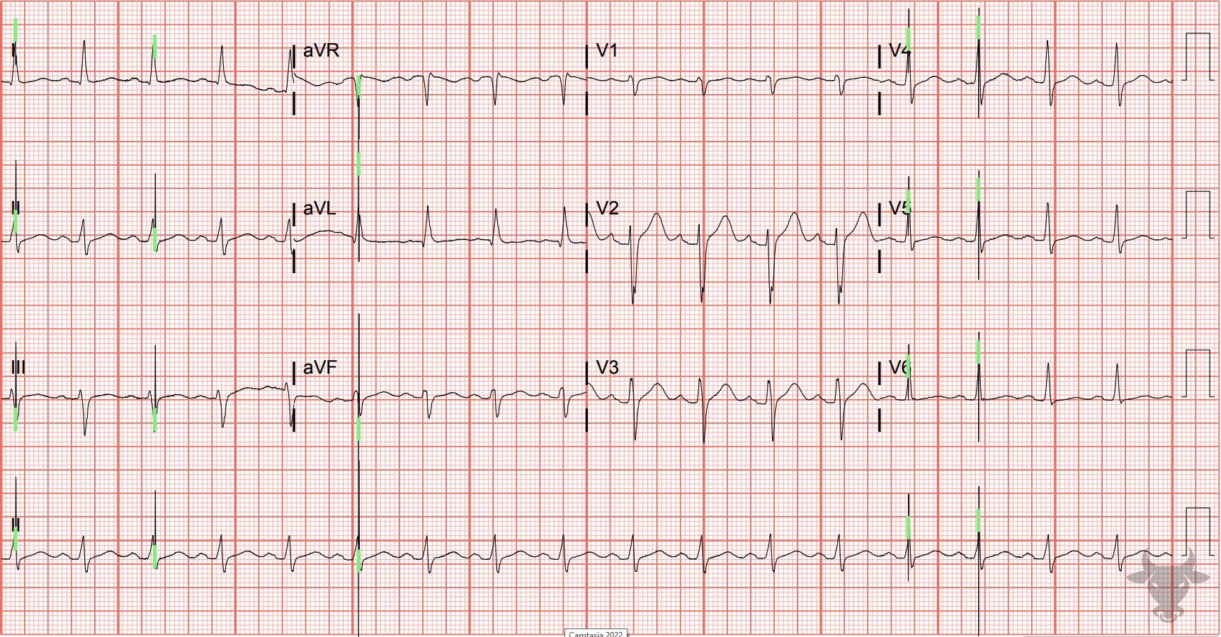 ECG Showing Pacemaker Malfunction