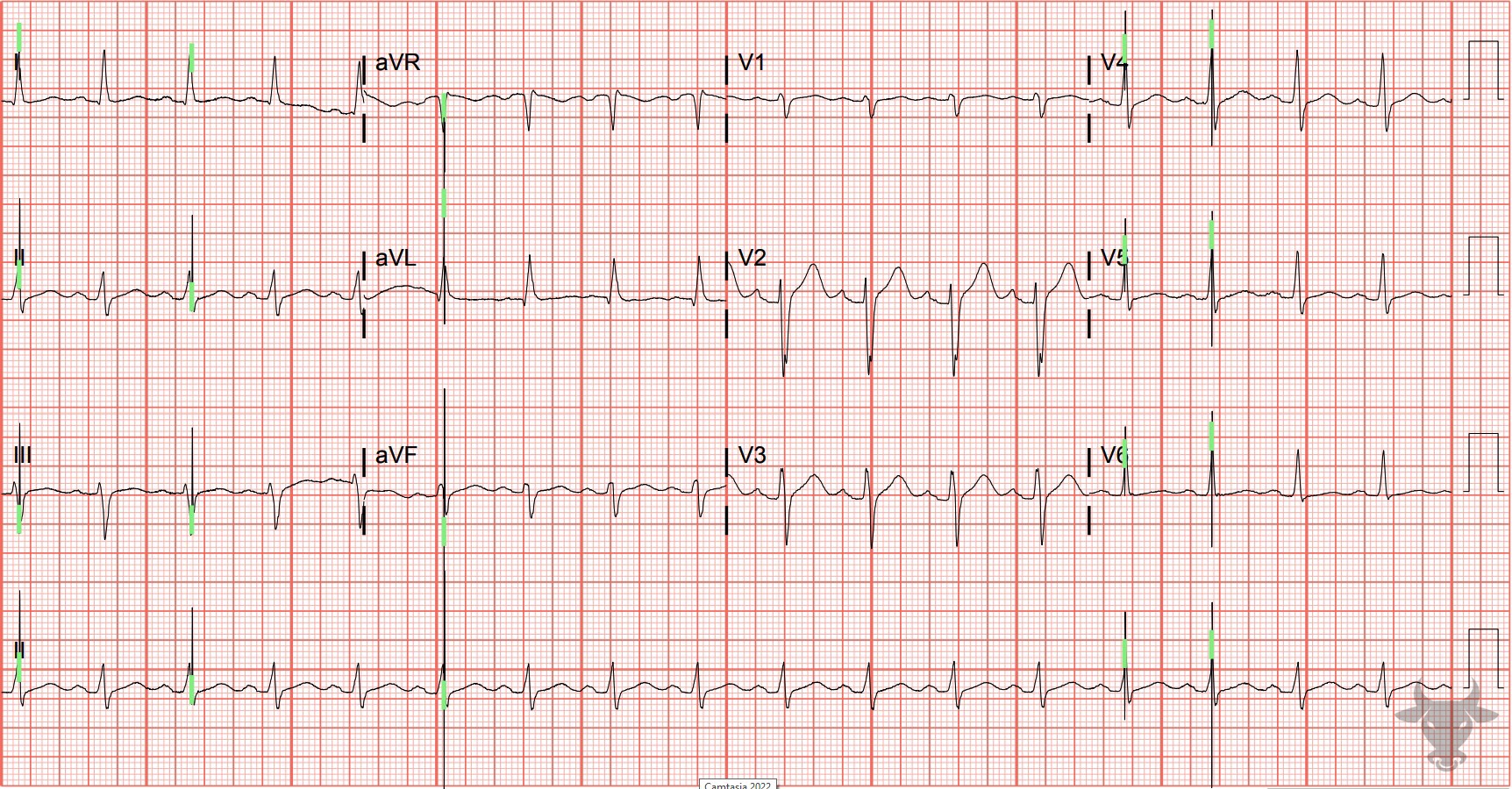 ECG Showing Pacemaker Malfunction