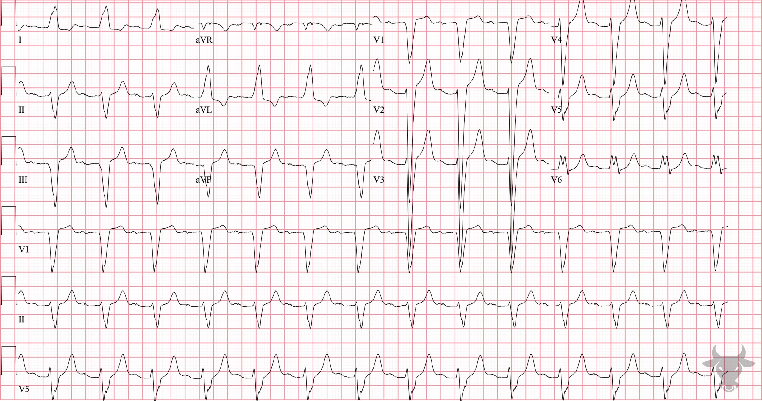 ECG Showing Left Bundle Branch Block