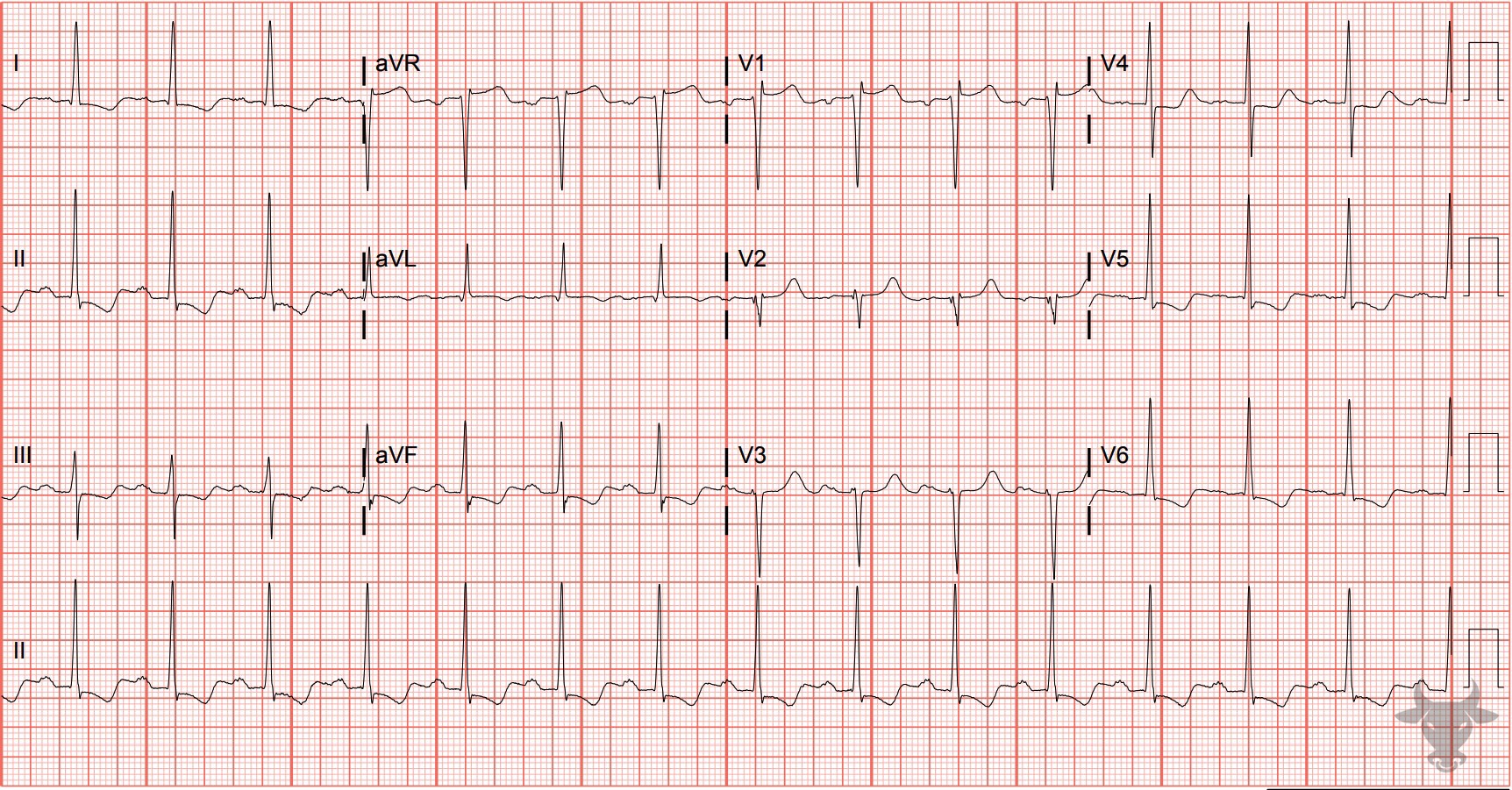 ECG Showing Left Ventricular Hypertrophy