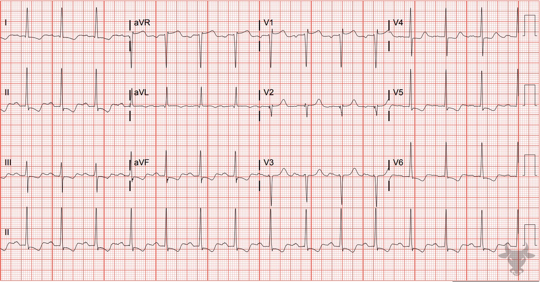 ECG Showing Left Ventricular Hypertrophy