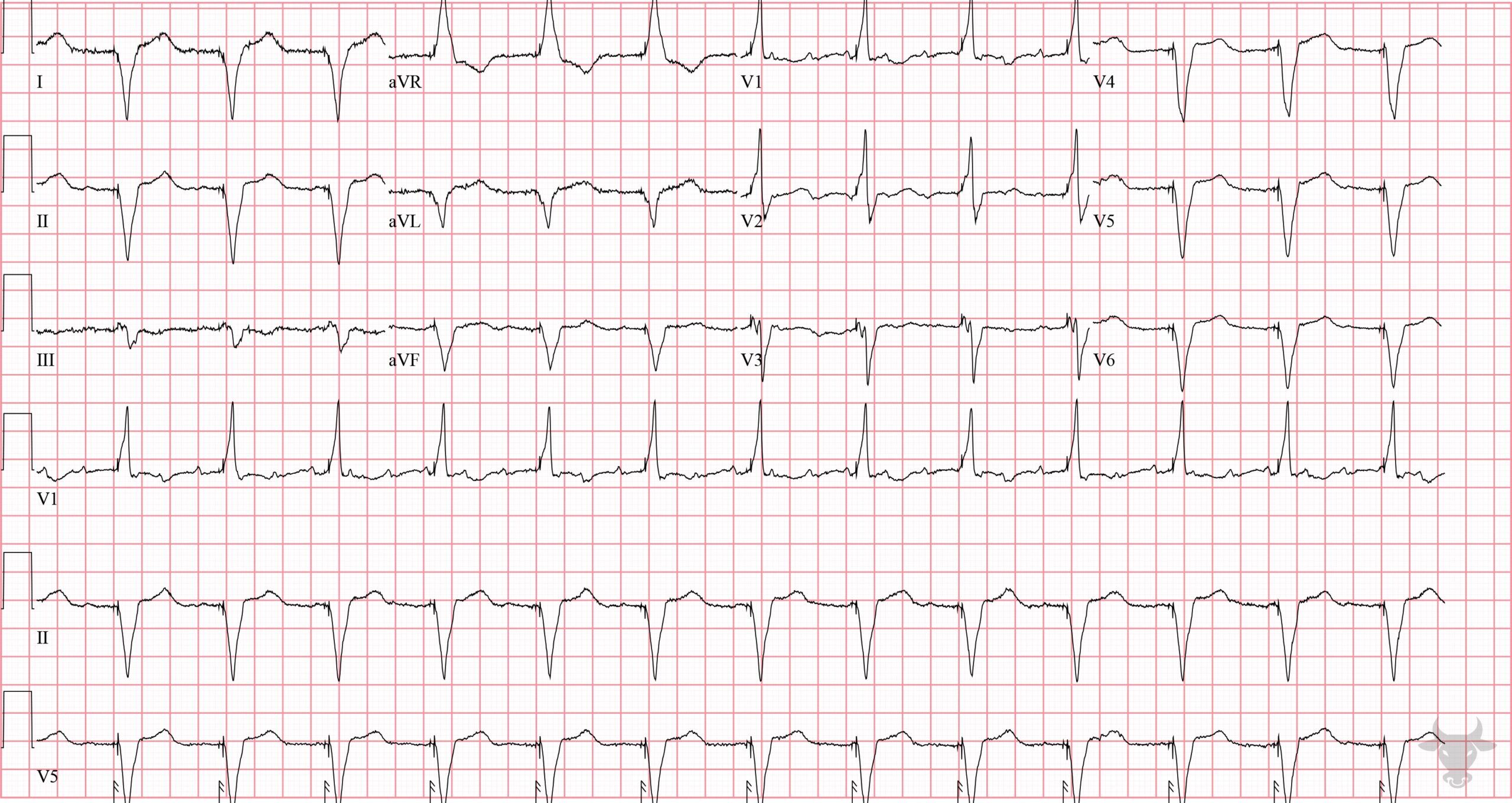 ECG Showing Paced Rhythm