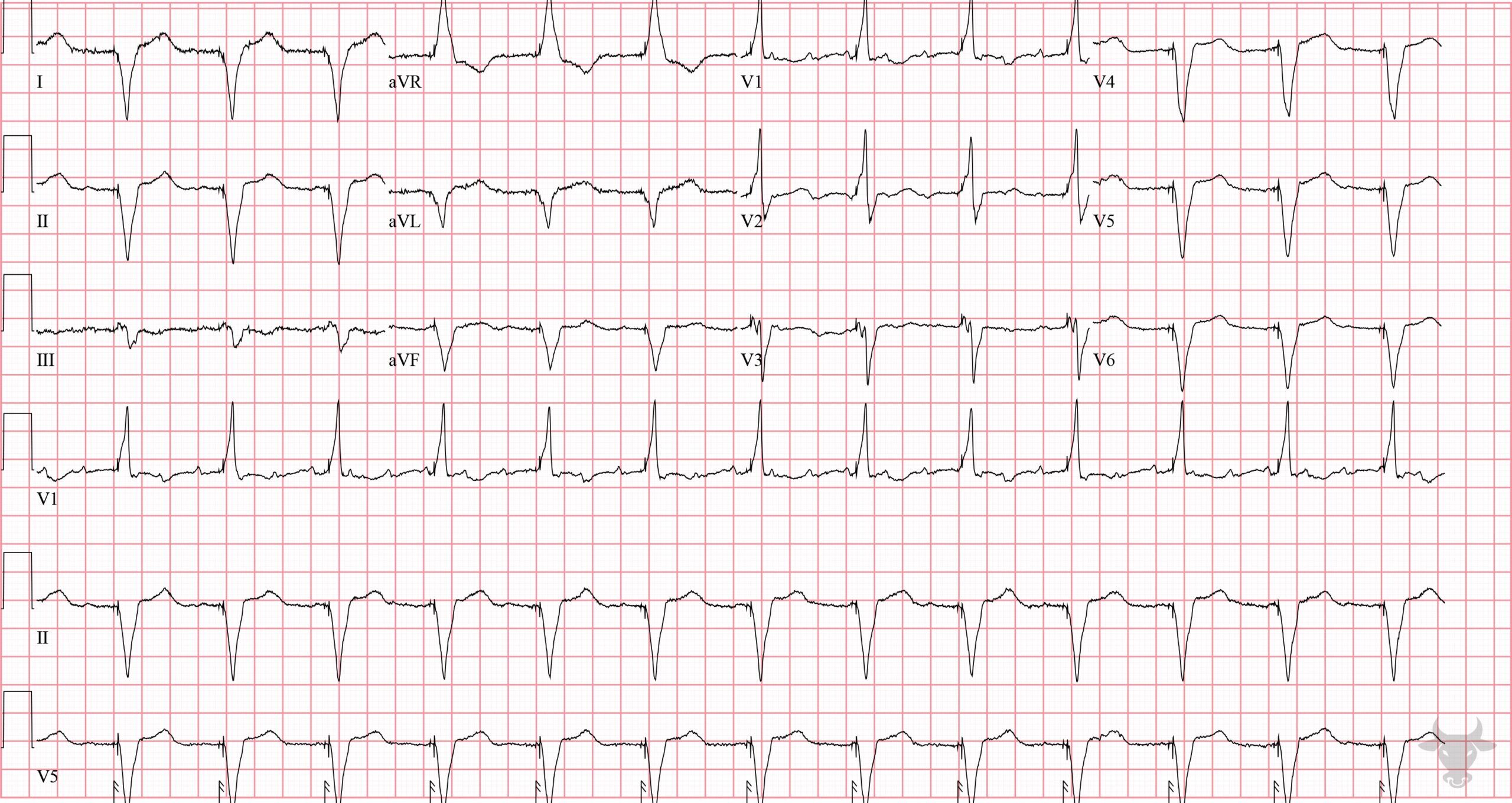 ECG Showing Paced Rhythm