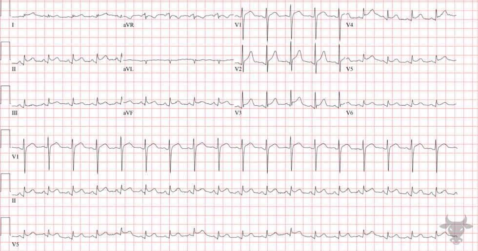 Acute Pericarditis | ECG Stampede