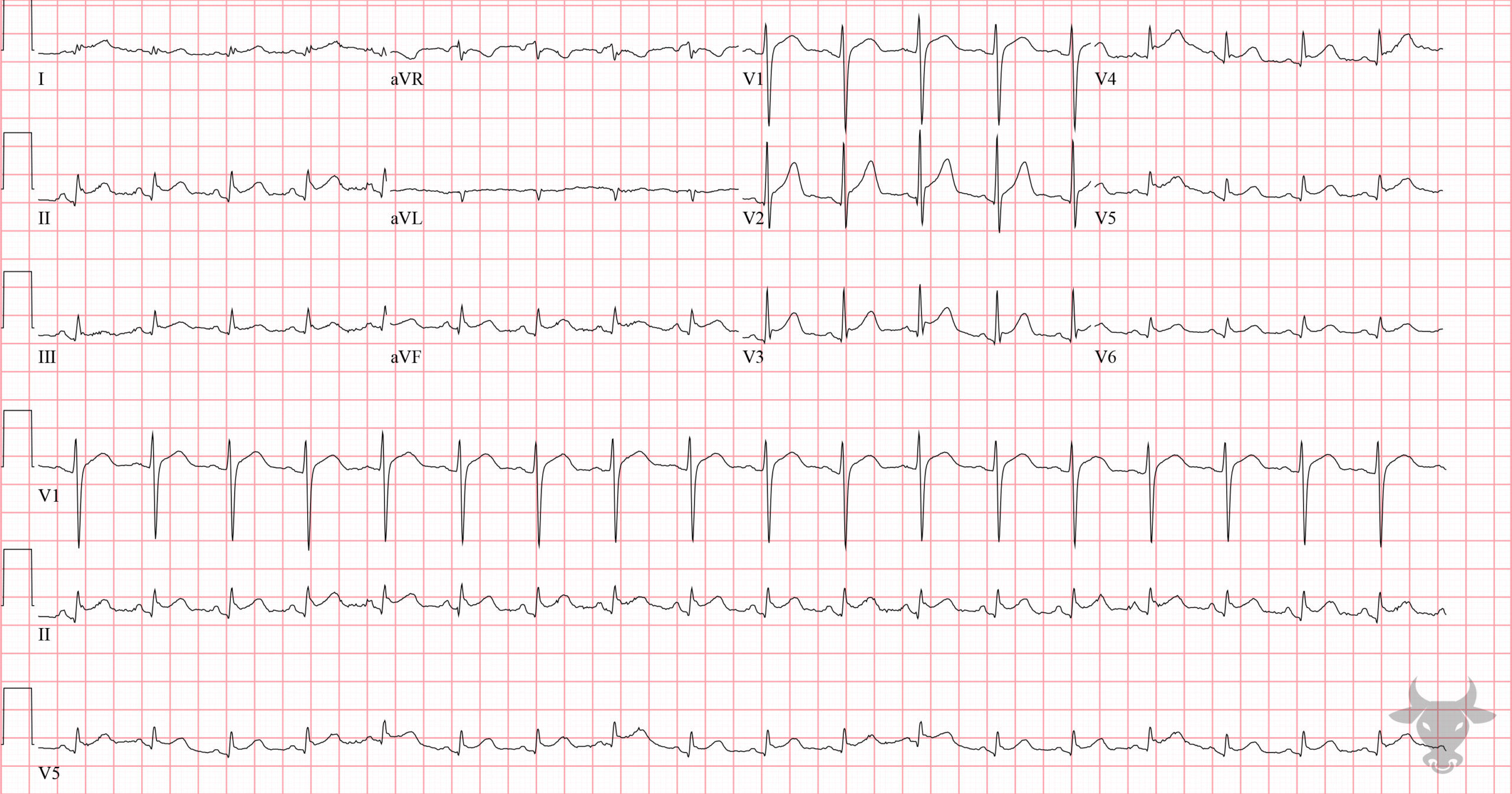 ECG Showing Acute Pericarditis