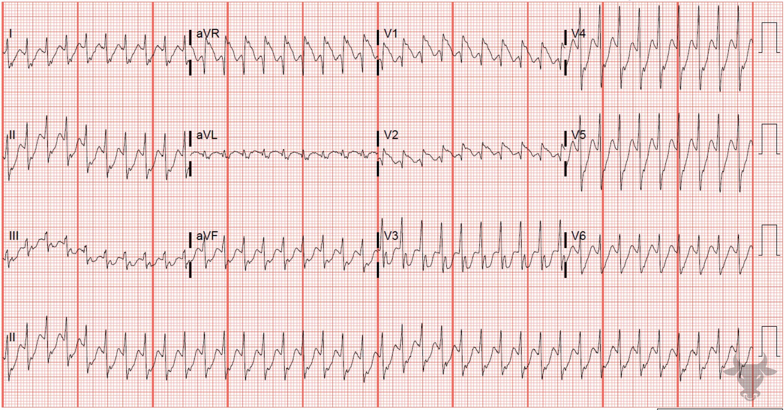 ECG Showing Ventricular Tachycardia
