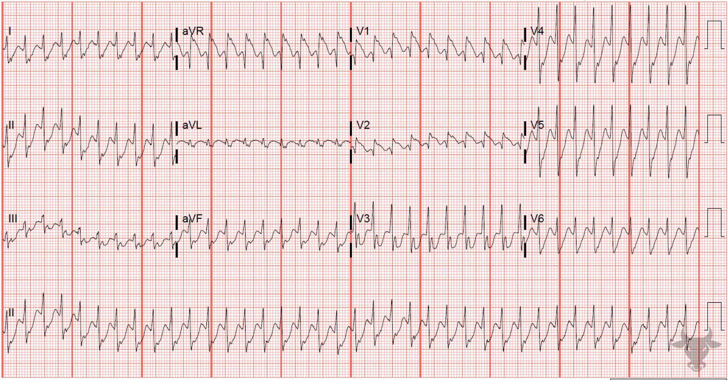 ECG Showing Ventricular Tachycardia