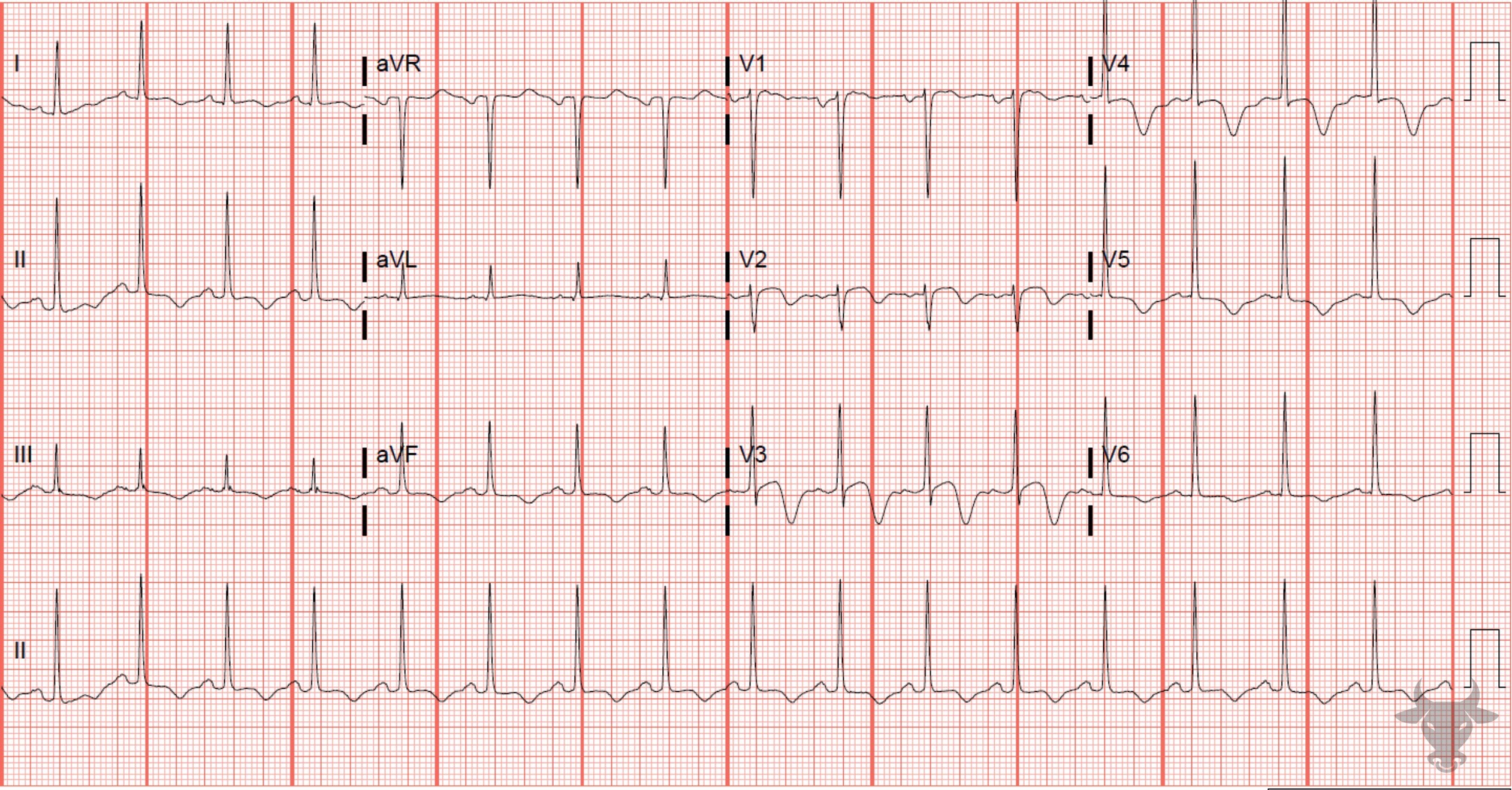 ECG Showing Atrial Flutter