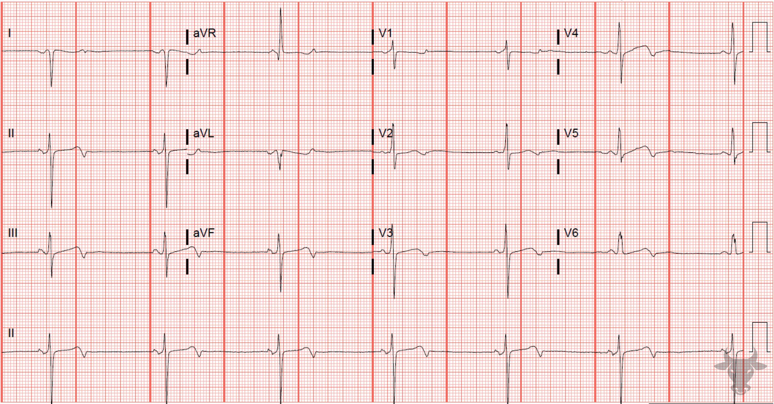 ECG Showing Limb Lead Reversal