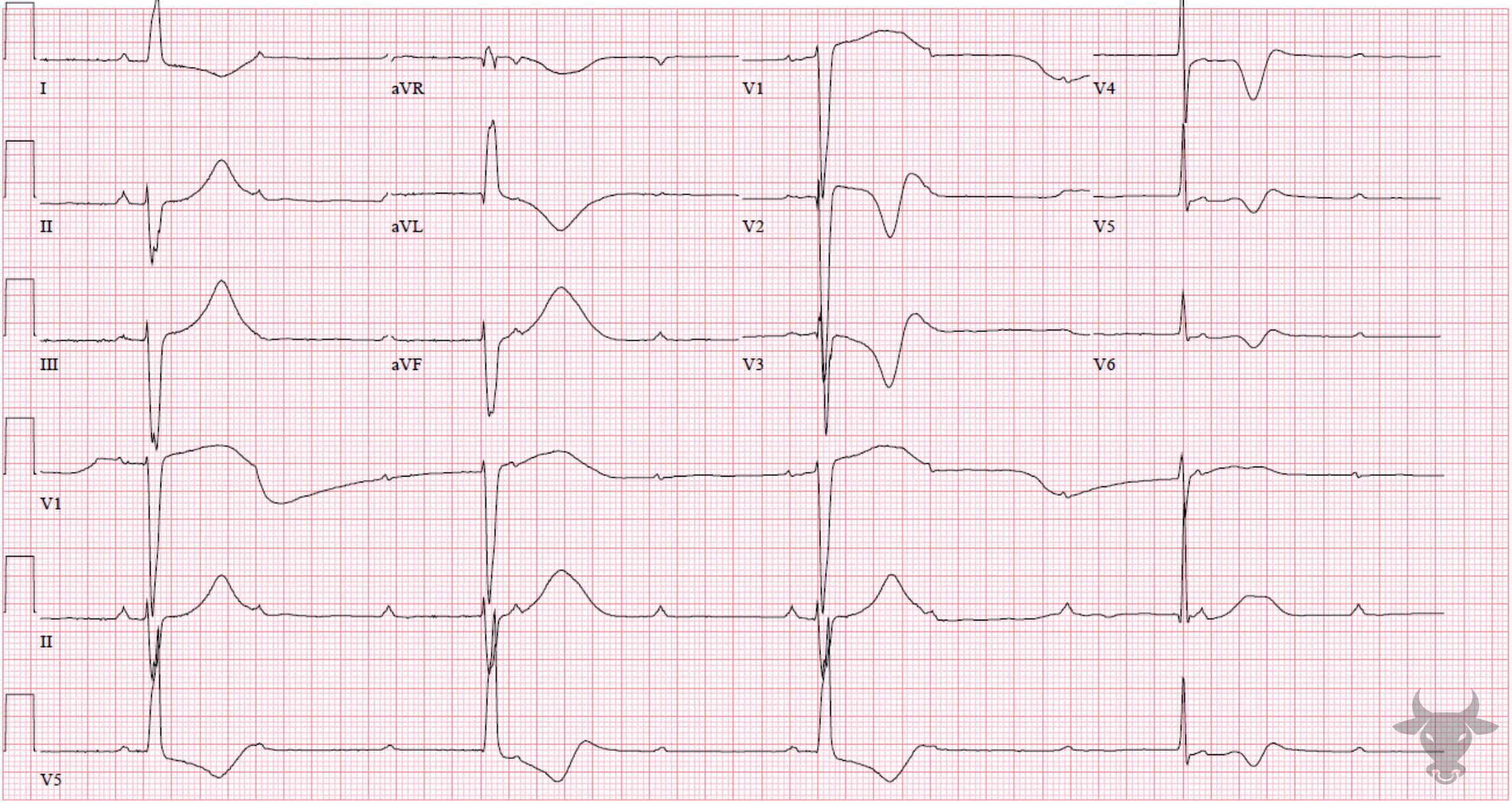 ECG Showing Third Degree Atrioventricular Block