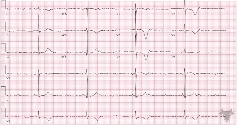 Second Degree Atrioventricular Block Mobitz II ECG Stampede