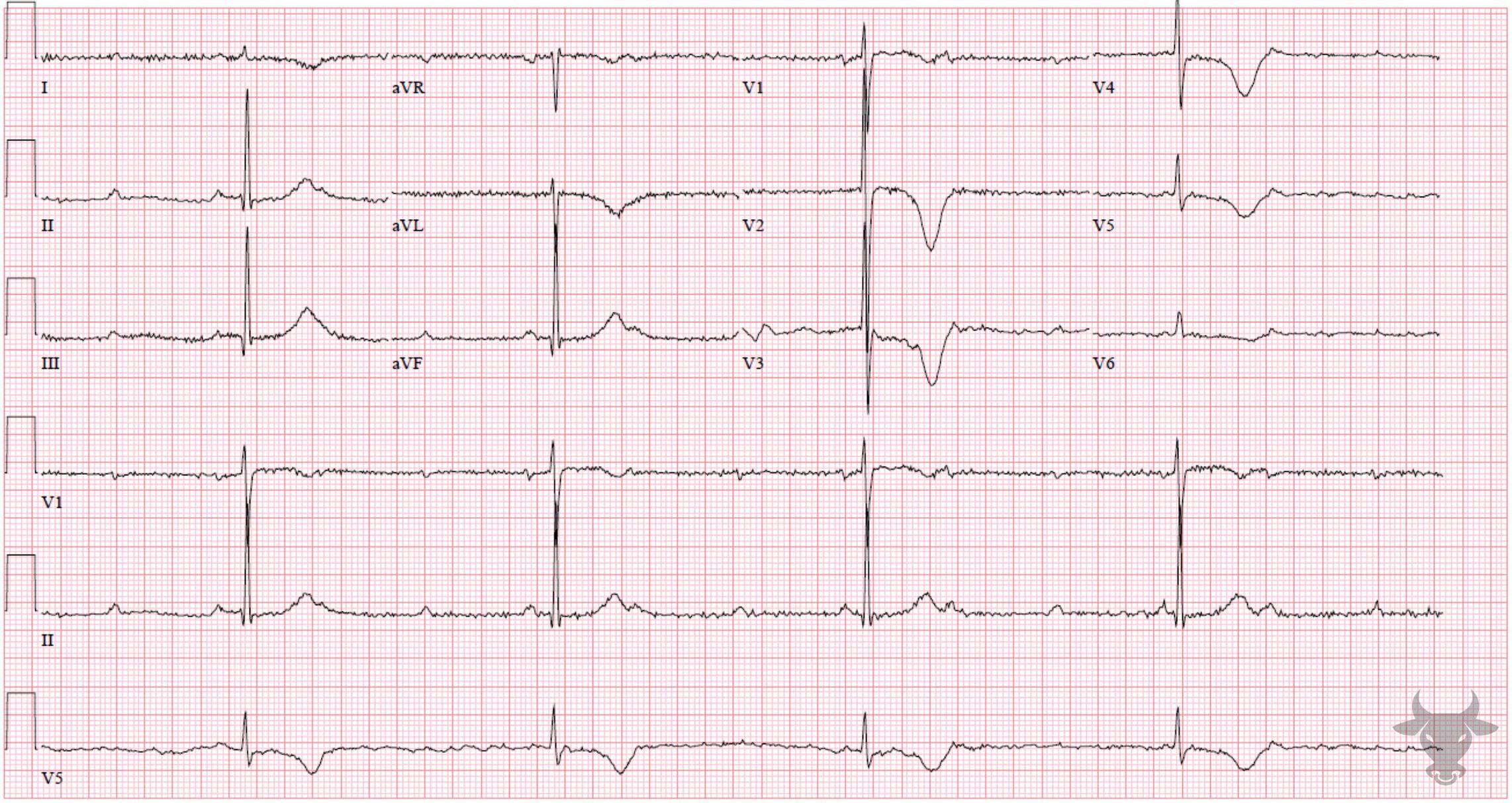 ECG Showing Second Degree Atrioventricular Block - Mobitz II