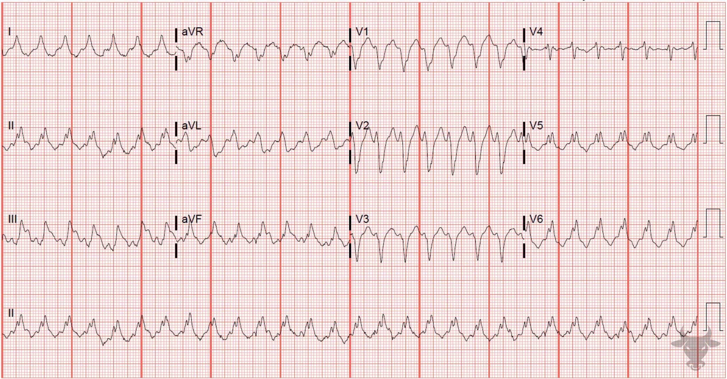 ECG Showing Ventricular Tachycardia