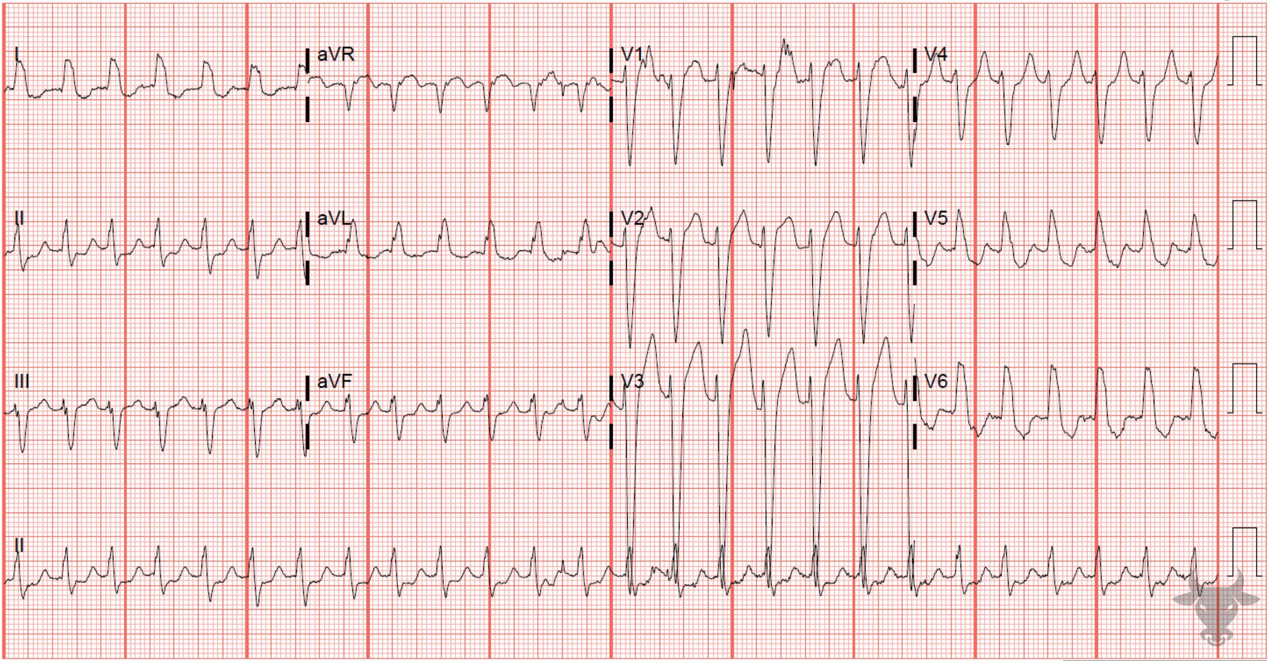 ECG Showing Supraventricular Tachycardia with Aberrancy