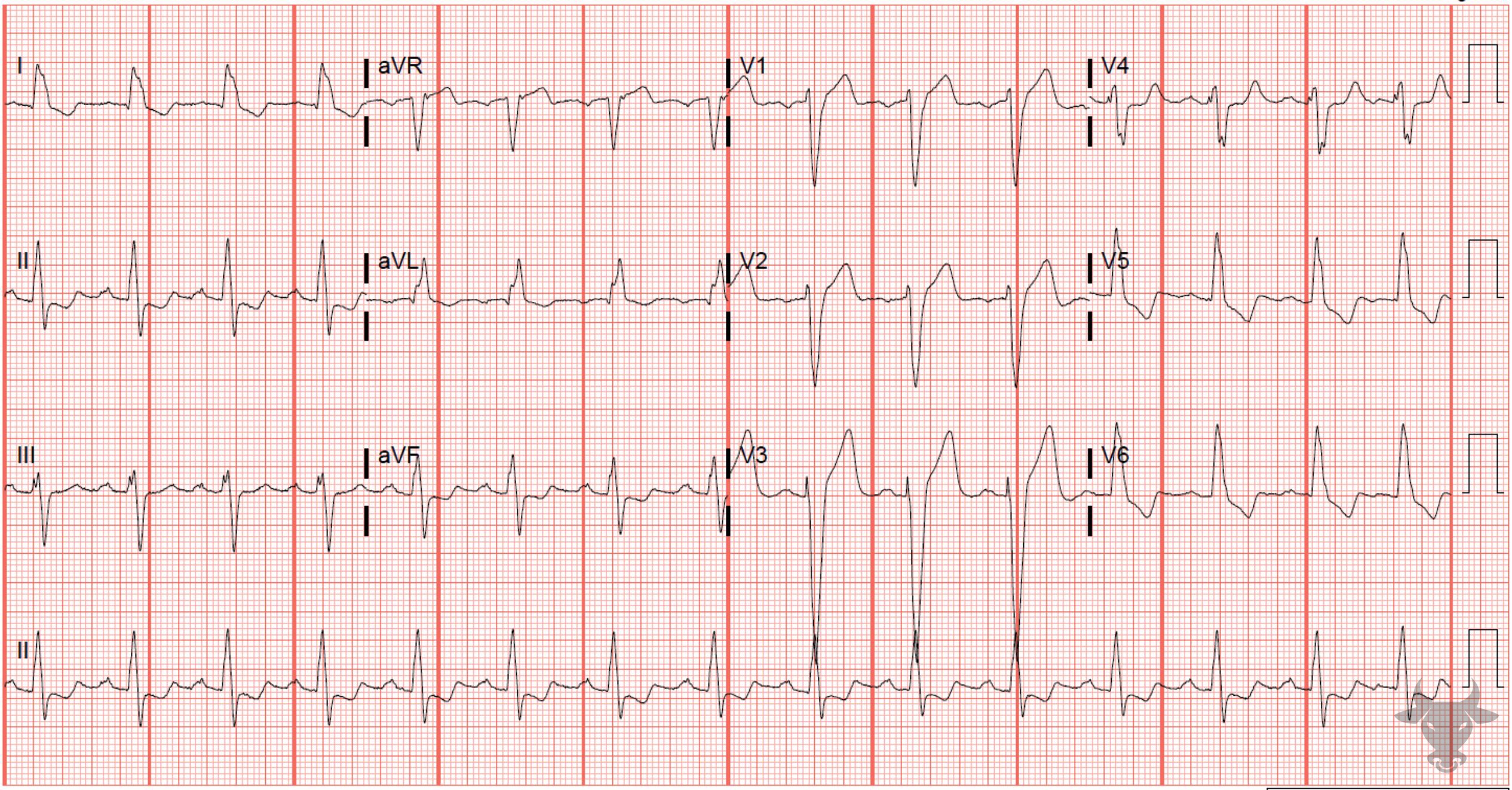 ECG Showing Left Bundle Branch Block